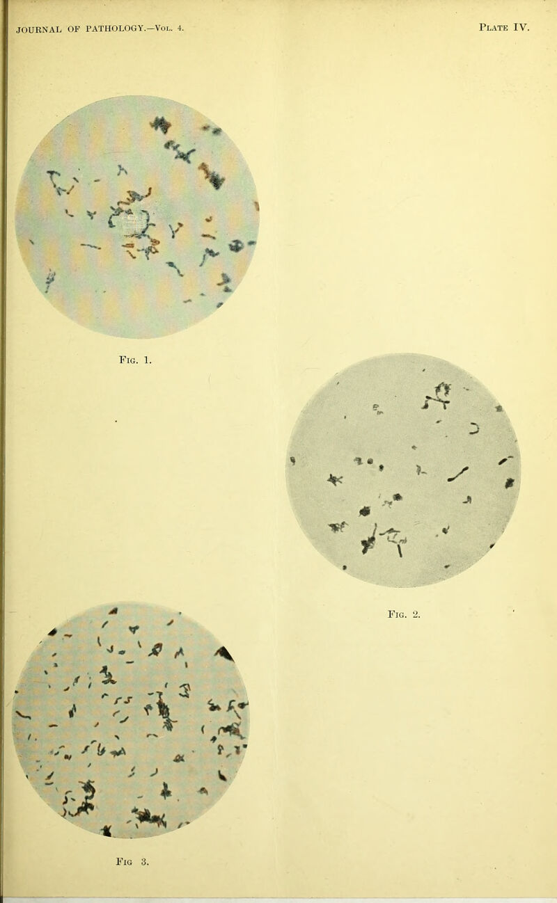 JOURNAL OF PATHOLOGY.—Vol. 4. Plate IV. Fig. 1. i ■*r * M A Fig. 2. Fig 3.