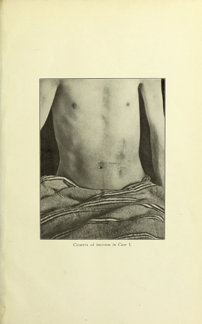 Cicatrix of incision in Case I.