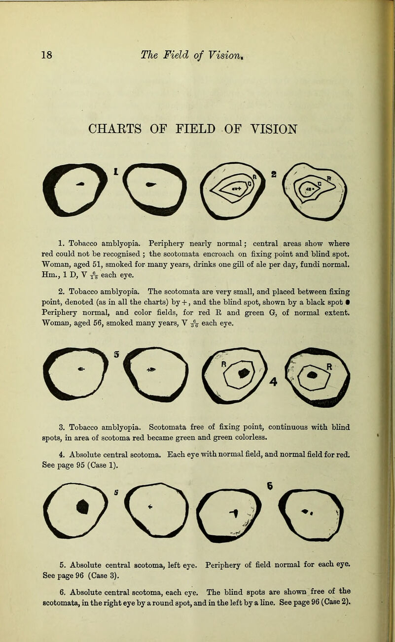 CHARTS OF FIELD OF VISION 1. Tobacco amblyopia. Periphery nearly normal; central areas show where red could not be recognised ; the scotomata encroach on fixing point and blind spot. Woman, aged 51, smoked for many years, drinks one gill of ale per day, fundi normal. Hm., 1 D, V x% each eye. 2. Tobacco amblyopia. The scotomata are very small, and placed between fixing point, denoted (as in all the charts) by +, and the blind spot, shown by a black spot • Periphery normal, and color fields, for red R and green G, of normal extent. WomaD, aged 56, smoked many years, V each eye. 3. Tobacco amblyopia. Scotomata free of fixing point, continuous with blind spots, in area of scotoma red became green and green colorless. 4. Absolute central scotoma. Each eye with normal field, and normal field for red. See page 95 (Case 1). 5. Absolute central scotoma, left eye. Periphery of field normal for each eye. See page 96 (Case 3). 6. Absolute central scotoma, each eye. The blind spots are shown free of the scotomata, in the right eye by a round spot, and in the left by a line. See page 96 (Case 2).