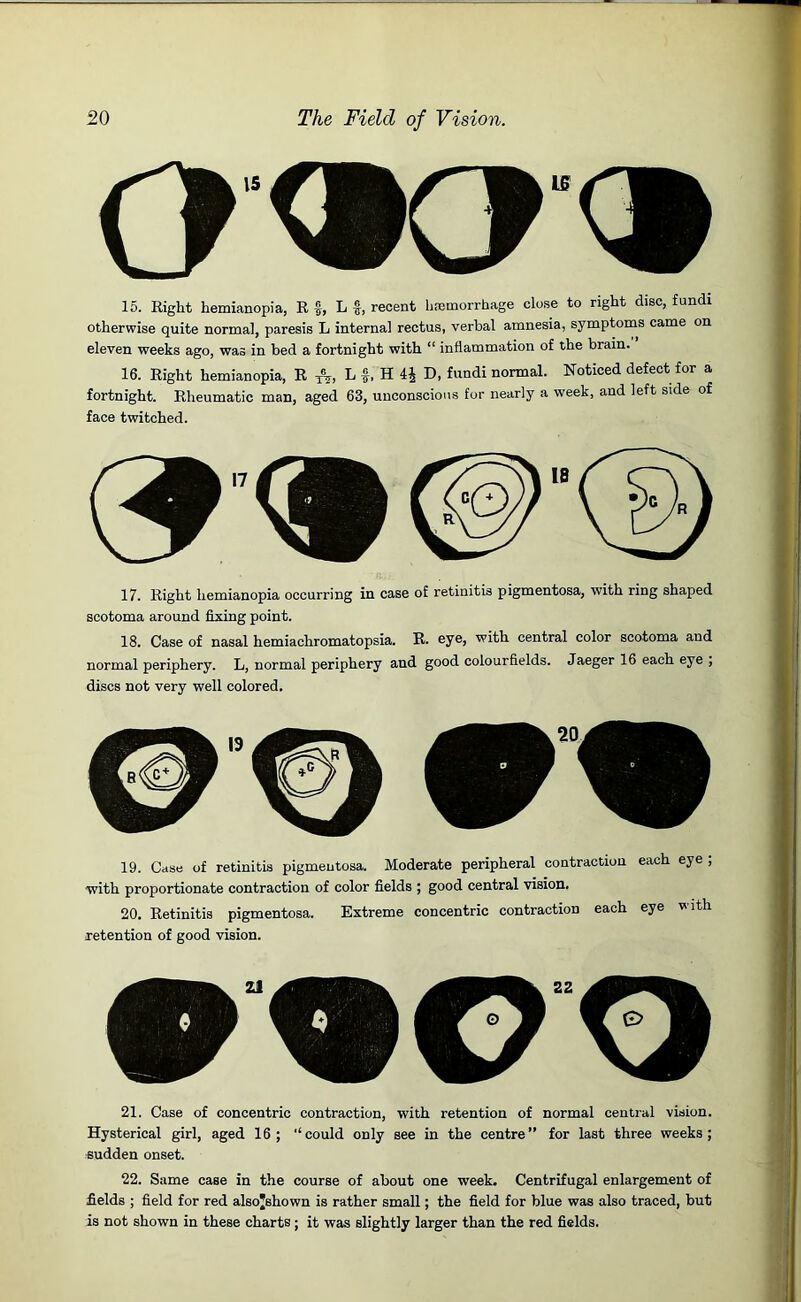 15. Right hemianopia, R f, L f, recent haemorrhage close to right disc, fundi otherwise quite normal, paresis L internal rectus, verbal amnesia, symptoms came on eleven weeks ago, was in bed a fortnight with “ inflammation of the brain. 16. Right hemianopia, R L f, H 4$ D, fundi normal. Noticed defect for a fortnight. Rheumatic man, aged 63, unconscious for nearly a week, and left side of face twitched. 17. Right hemianopia occurring in case of retinitis pigmentosa, with ring shaped scotoma around fixing point. 18. Case of nasal hemiachromatopsia. R. eye, with central color scotoma and normal periphery. L, normal periphery and good colourfields. Jaeger 16 each eye , discs not very well colored. 19. Case of retinitis pigmentosa. Moderate peripheral contraction each eye ; with proportionate contraction of color fields ; good central vision. 20. Retinitis pigmentosa. Extreme concentric contraction each eye v ith retention of good vision. 21. Case of concentric contraction, with retention of normal central vision. Hysterical girl, aged 16; “could only see in the centre” for last three weeks; sudden onset. 22. Same case in the course of about one week. Centrifugal enlargement of fields ; field for red alsojshown is rather small; the field for blue was also traced, but is not shown in these charts ; it was slightly larger than the red fields.