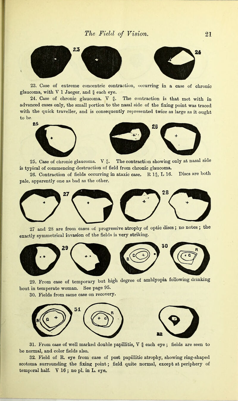 23. Case of extreme concentric contraction, occurring in a case of chronic glaucoma, with V 1 Jaeger, and § each eye. 24. Case of chronic glaucoma. V f. The contraction is that met with in advanced cases only, the small portion to the nasal side of the fixing point was traced with the quick traveller, and is consequently represented twice as large as it ought to be. 25. Case of chronic glaucoma. V The contraction showing only at nasal side is typical of commencing destruction of field from chronic glaucoma. 26. Contraction of fields occurring in ataxic case. R If, L 16. Discs are both pale, apparently one as bad as the other. 27 and 28 are from cases of progressive atrophy of optic discs; no notes ; the exactly symmetrical invasion of the fields is very striking. 29 29. From case of temporary but high degree of amblyopia following drinking bout in temperate woman. See page 95. 30. Fields from same case on recovery. 31. From case of well marked double papillitis, V £ each eye ; fields are seen to be normal, and color fields also. 32. Field of R. eye from case of post papillitic atrophy, showing ring-shaped scotoma surrounding the fixing point; field quite normal, except at periphery of temporal half. V 16 ; no pi. in L. eye.