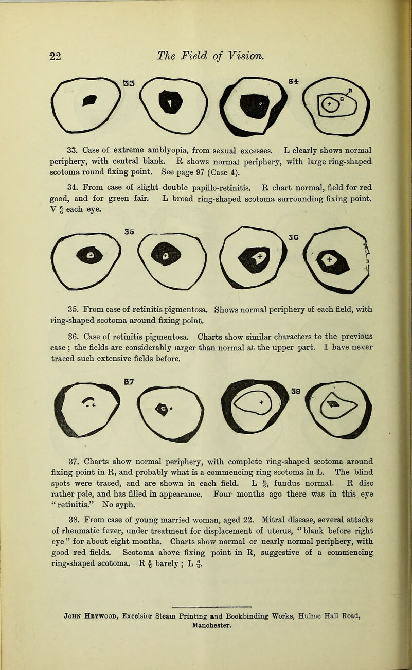 33. Case of extreme amblyopia, from sexual excesses. L clearly shows normal periphery, with central blank. R shows normal periphery, with large ring-shaped scotoma round fixing point. See page 97 (Case 4). 34. From case of slight double papillo-retinitis. R chart normal, field for red good, and for green fair. L broad ring-shaped scotoma surrounding fixing point. V -g each eye. 35. From case of retinitis pigmentosa. Shows normal periphery of each field, with ring-shaped scotoma around fixing point. 36. Case of retinitis pigmentosa. Charts show similar characters to the previous case ; the fields are considerably larger than normal at the upper part. I have never traced such extensive fields before. 37. Charts show normal periphery, with complete ring-shaped scotoma around fixing point in R, and probably what is a commencing ring scotoma in L. The blind spots were traced, and are shown in each field. L ■§, fundus normal. R disc rather pale, and has filled in appearance. Four months ago there was in this eye “retinitis.” No syph. 38. From case of young married woman, aged 22. Mitral disease, several attacks of rheumatic fever, under treatment for displacement of uterus, “ blank before right eye ” for about eight months. Charts show normal or nearly normal periphery, with good red fields. Scotoma above fixing point in R, suggestive of a commencing ring-shaped scotoma. R f barely ; L f. John Hiywood, Excelsior Steam Printing and Bookbinding Works, Hulme Hall Road, Manchester.