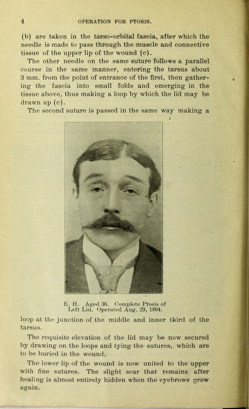 (b) are taken in the tarso-orbital fascia, after which the needle is made to pass through the muscle and connective tissue of the upper lip of the wound (c). The other needle on the same suture follows a parallel course in the same manner, entering the tarsus about 3 mm. from the point of entrance of the first, then gather- ing the fascia into small folds and emerging in the tissue above, thus making a loop by which the lid may be drawn up (c). The second suture is passed in the same way making a E. H. Aged 3G. Complete Ptosis of Left Lid. Operated Aug. 29, 1894. loop at the junction of the middle and inner third of the tarsus. The requisite elevation of the lid may be now secured by drawing on the loops and tying the sutures, which are to be buried in the wound. The lower lip of the wound is now united to the upper with fine sutures. The slight scar that remains after healing is almost entirely hidden when the eyebrows grow again.