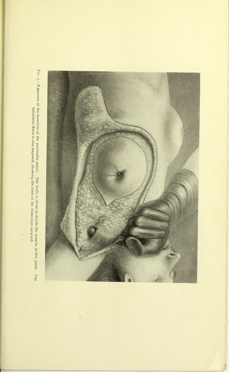 -Exposure of the insertion of the peetoralis major. The knife is about to divide the muscle at this point. The latissimus dorsi is also exposed, showing the limit of the dissection outward.