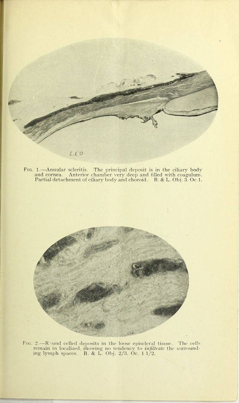 t.lp Fig. 1.—Annular scleritis. The principal deposit is in the ciliary body and cornea. Anterior chamber very deep and filled with coagulum. Partial detachment of ciliary body and choroid. B. & L. Obp 3. Oc.l. Fig. 2.—RTund celled dejiosits in the loose episcleral tissue. 'I'he cells remain in localized, showing no tendency to infiltrate the surround-