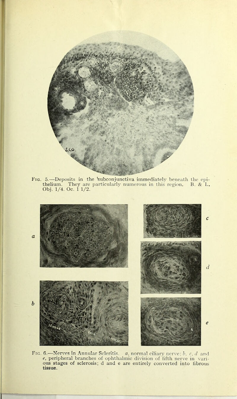 thelium. They are particularly numerous in this region. B. & L. Obj. 1/4. Oc. 1 1/2. i| Ii if ''i Frc. 6.—Ner\’’es in Annular Scleritis. a, normal ciliary nerve; b, c, d and e, peripheral branches of ophthalmic division of fifth nerve in vari- ous stages of sclerosis; d and e are entirely converted into fibrous tissue.