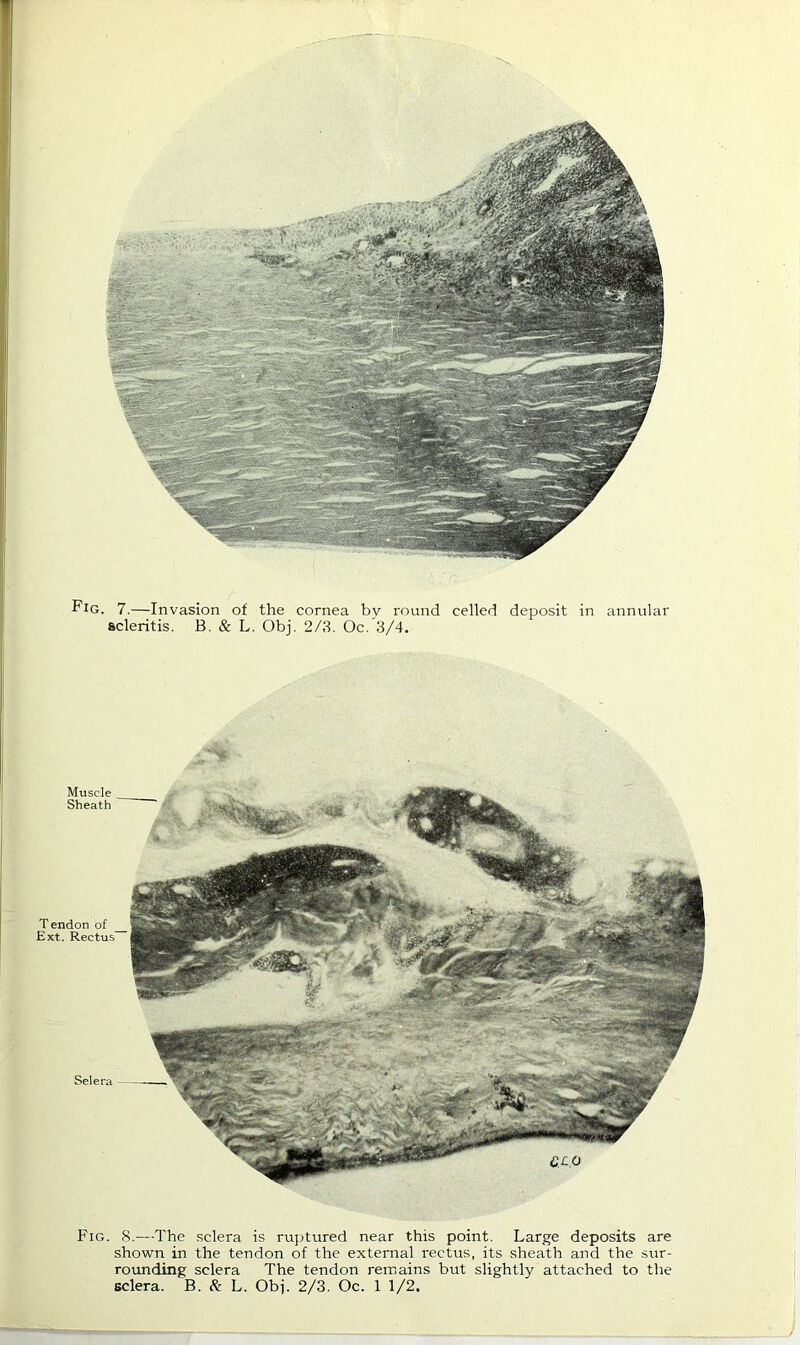 7.—Invasion of the cornea by I'ound celled deposit in annular ficleritis. B. & L. Obj. 2/3. Oc. 3/4. Tendon of Ext. Rectus* Selera - ^£0 Muscle Sheath Fig. S.—The .sclera is ru];tured near this point. Large deposits are shown in the tendon of the external rectus, its sheath and the sur- rounding sclera The tendon remains but slightly attached to the