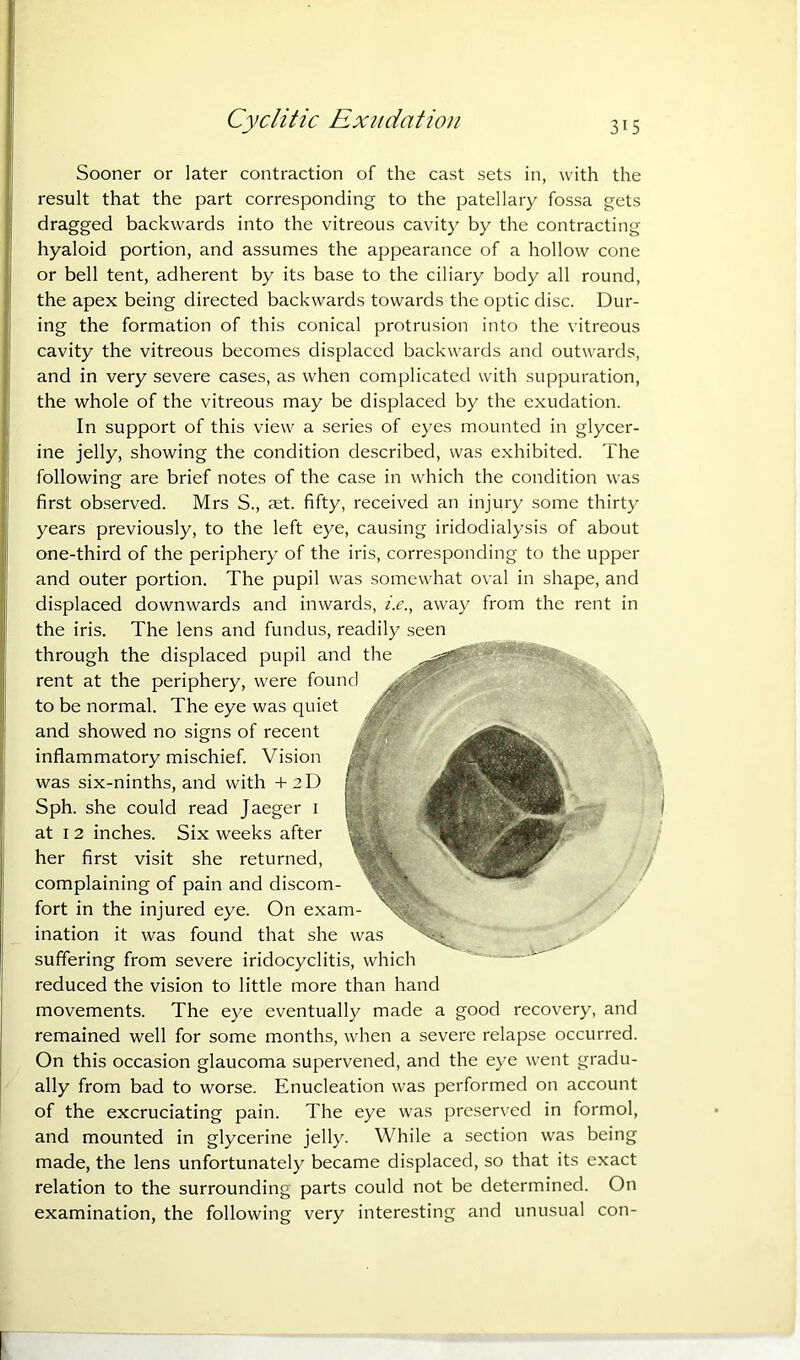 Sooner or later contraction of the cast sets in, with the result that the part corresponding to the patellary fossa gets dragged backwards into the vitreous cavity by the contracting hyaloid portion, and assumes the appearance of a hollow cone or bell tent, adherent by its base to the ciliary body all round, the apex being directed backwards towards the optic disc. Dur- ing the formation of this conical protrusion into the vitreous cavity the vitreous becomes displaced backwards and outwards, and in very severe cases, as when complicated with suppuration, the whole of the vitreous may be displaced by the exudation. In support of this view a series of eyes mounted in glycer- ine jelly, showing the condition described, was exhibited. The following are brief notes of the case in which the condition was first observed. Mrs S., set. fifty, received an injury some thirty years previously, to the left eye, causing iridodialysis of about one-third of the periphery of the iris, corresponding to the upper and outer portion. The pupil was somewhat oval in shape, and displaced downwards and inwards, i.e., away from the rent in the iris. The lens and fundus, readily seen through the displaced pupil and the rent at the periphery, were found to be normal. The eye was quiet and showed no signs of recent inflammatory mischief. Vision was six-ninths, and with -f2D Sph. she could read Jaeger i at I 2 inches. Six weeks after her first visit she returned, complaining of pain and discom- fort in the injured eye. On exam- ination it was found that she was suffering from severe iridocyclitis, which reduced the vision to little more than hand movements. The eye eventually made a good recovery, and remained well for some months, when a severe relapse occurred. On this occasion glaucoma supervened, and the eye went gradu- ally from bad to worse. Enucleation was performed on account of the excruciating pain. The eye was preserved in formol, and mounted in glycerine jelly. While a section was being made, the lens unfortunately became displaced, so that its exact relation to the surrounding parts could not be determined. On examination, the following very interesting and unusual con-