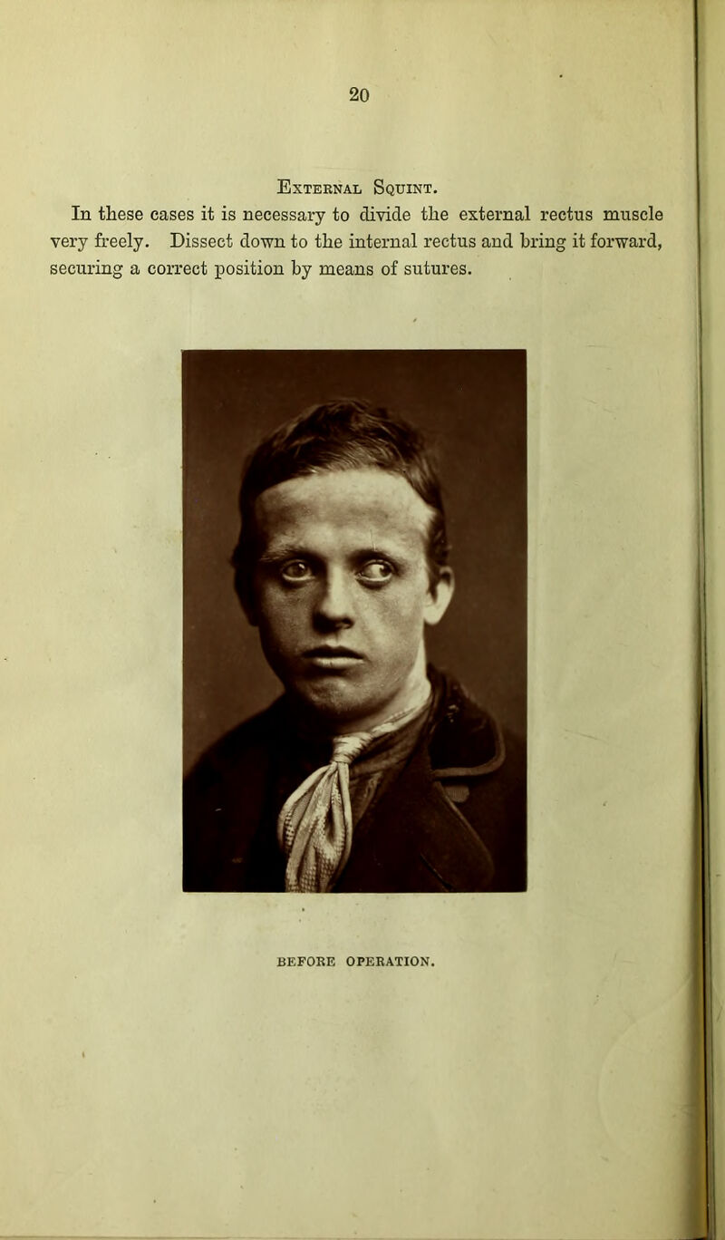 External Squint. In these cases it is necessary to divide the external rectus muscle very freely. Dissect down to the internal rectus and bring it forward, securing a correct position by means of sutures. BEFORE OPERATION.