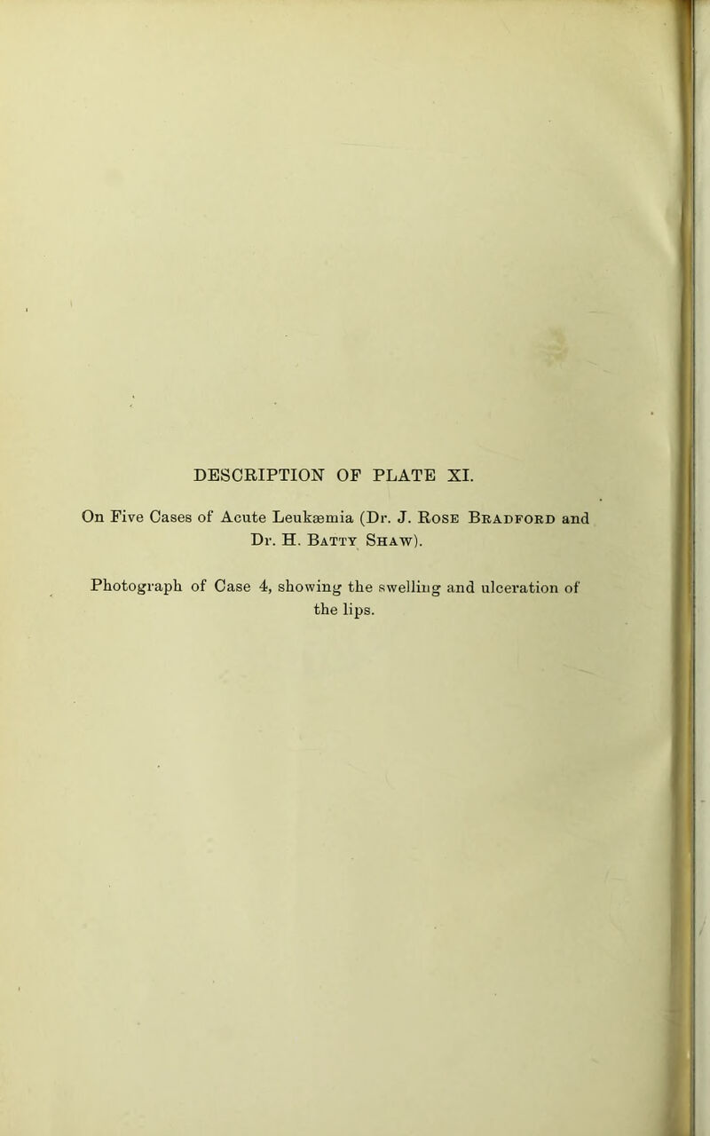 On Five Oases of Acute Leukaemia (Dr. J. Rose Bradford and Dr. H. Batty Shaw). Photograph of Case 4, showing the swelling and ulceration of the lips.