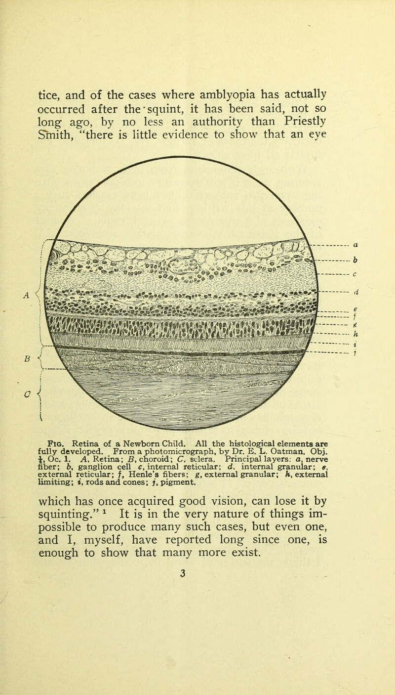 tice, and of the cases where amblyopia has actually occurred after the’squint, it has been said, not so long ago, by no less an authority than Priestly Smith, “there is little evidence to show that an eye Fig. Retina of a Newborn Child. All the histological elements are fully developed. From a photomicrograph, by Dr. E. L. Oatman. Obj. i, Oc. 1. A, Retina; B, choroid; C, sclera. Principal layers: a, nerve fiber; b, ganglion cell c, internal reticular; d. internal granular; e, external reticular; f, Henle’s fibers; g, external granular; h, external limiting; *, rods and cones; j, pigment. which has once acquired good vision, can lose it by squinting.” 1 It is in the very nature of things im- possible to produce many such cases, but even one, and I, myself, have reported long since one, is enough to show that many more exist.