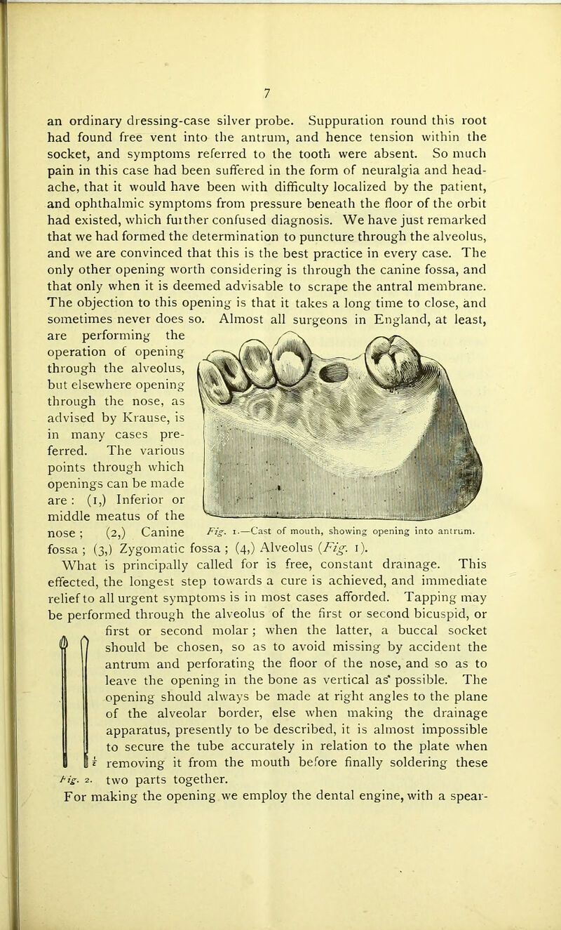 an ordinary dressing-case silver probe. Suppuration round this root had found free vent into the antrum, and hence tension within the socket, and symptoms referred to the tooth were absent. So much pain in this case had been suffered in the form of neuralgia and head- ache, that it would have been with difficulty localized by the patient, and ophthalmic symptoms from pressure beneath the floor of the orbit had existed, which further confused diagnosis. We have just remarked that we had formed the determination to puncture through the alveolus, and we are convinced that this is the best practice in every case. The only other opening worth considering is through the canine fossa, and that only when it is deemed advisable to scrape the antral membrane. The objection to this opening is that it takes a long time to close, and sometimes never does so. Almost all surgeons in England, at least, are performing the operation of opening through the alveolus, but elsewhere opening through the nose, as advised by Krause, is in many cases pre- ferred. The various points through which openings can be made are : (i,) Inferior or middle meatus of the nose; (2,) Canine Pis- j fossa ; (3,) Zygomatic fossa ; What is principally called opening into antrum. [.—Cast of mouth, showing (4,) Alveolus {Fig. i). for is free, constant drainage. This effected, the longest step towards a cure is achieved, and immediate relief to all urgent symptoms is in most cases afforded. Tapping may be performed through the alveolus of the first or second bicuspid, or first or second molar; when the latter, a buccal socket ^ 0 should be chosen, so as to avoid missing by accident the antrum and perforating the floor of the nose, and so as to leave the opening in the bone as vertical as* possible. The opening should always be made at right angles to the plane of the alveolar border, else when making the drainage apparatus, presently to be described, it is almost impossible to secure the tube accurately in relation to the plate when removing it from the mouth before finally soldering these 2. two parts together. For making the opening we employ the dental engine, with a spear-