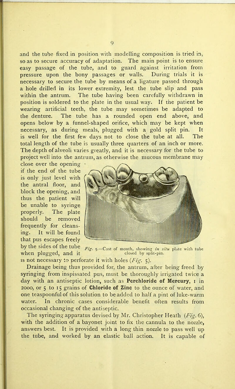 and the tube fixed in position with modelling composition is tried in, so as to secure accuracy of adaptation. The main point is to ensure easy passage of the tube, and to guard against irritation from pressure upon the bony passages or walls. During trials it is necessary to secure the tube by means of a ligature passed through a hole drilled in its lower extremity, lest the tube slip and pass within the antrum. The tube having been carefully withdrawn in position is soldered to the plate in the usual way. If the patient be wearing artificial teeth, the tube may sometimes be adapted to the denture. The tube has a rounded open end above, and opens below by a funnel-shaped orifice, which may be kept when necessary, as during meals, plugged with a gold split pin. It is well for the first few days not to close the tube at all. The total length of the tube is usually three quarters of an inch or more. The depth of alveoli varies greatly, and it is necessary for the tube to project well into the antrum, as otherwise the mucous membrane may close over the opening if the end of the tube is only just level with the antral floor, and block the opening, and thus the patient will be unable to syringe properly. The plate should be removed frequently for cleans- ing. It will be found that pus escapes freely by the sides of the tube tube when plugged, and it dosed by split-pin. IS not necessary to perforate it with holes {Fig. 5). Drainage being thus provided for, the antrum, after being freed by syringing from inspissated pus, must be thoroughly irrigated twice a day with an antiseptic lotion, such as Perchloride of Mercury, i in 2000, or 5 to 15 grains of Chloride of Zinc to the ounce of water, and one teaspoonful of this solution to be added to half a pint of luke-warm water. In chronic cases considerable benefit often results from occasional changing of the antiseptic. The syringing apparatus devised by Mr. Christopher Heath {Fig. 6), with the addition of a bayonet joint to fix the cannula to the nozzle, answers best. It is provided with a long thin nozzle to pass well up the tube, and worked by an elastic ball action. It is capable of