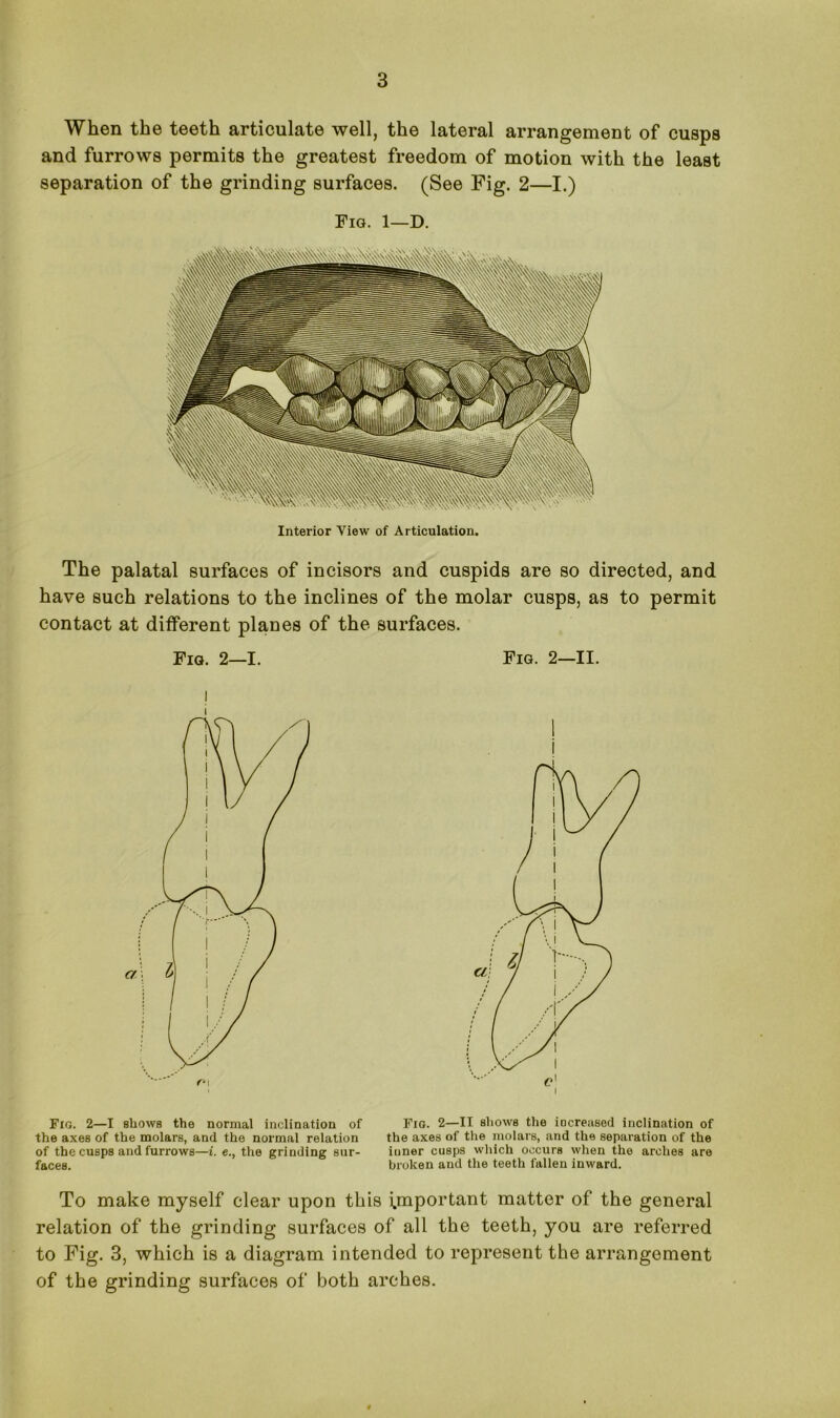 When the teeth articulate well, the lateral arrangement of cusps and furrows permits the greatest freedom of motion with the least separation of the grinding surfaces. (See Fig. 2—I.) Fig. 1—D. Interior View of Articulation. The palatal surfaces of incisors and cuspids are so directed, and have such relations to the inclines of the molar cusps, as to permit contact at different planes of the surfaces. Fig. 2—1. Fig. 2—II. i Fig. 2—I shows the normal inclination of the axes of the molars, and the normal relation of the cusps and furrows—i. e., the grinding sur- faces. Fig. 2—II sliows the increased inclination of the axes of the molars, and the separation of the inner cusps which occurs when the arches are broken and the teeth fallen inward. To make myself clear upon this important matter of the general relation of the grinding surfaces of all the teeth, you are referred to Fig. 3, which is a diagram intended to represent the arrangement of the grinding surfaces of both arches.