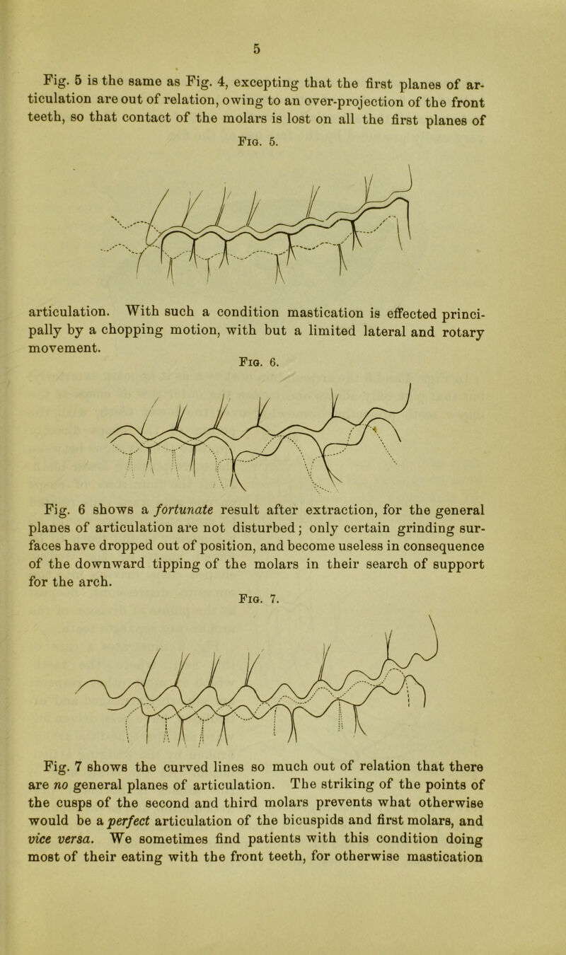 Fig. 5 is the same as Fig. 4, excepting that the first planes of ar- ticulation are out of relation, owing to an over-projection of the front teeth, so that contact of the molars is lost on all the first planes of Fig. 5. articulation. With such a condition mastication is effected princi- pally by a chopping motion, with but a limited lateral and rotary movement. Fig. 6. Fig. 6 shows a fortunate result after extraction, for the general planes of articulation are not disturbed; only certain grinding sur- faces have dropped out of position, and become useless in consequence of the downward tipping of the molars in their search of support for the arch. Fig. 7. Fig. 7 shows the curved lines so much out of relation that there are no general planes of articulation. The striking of the points of the cusps of the second and third molars prevents what otherwise would be a perfect articulation of the bicuspids and first molars, and vice versa. We sometimes find patients with this condition doing most of their eating with the front teeth, for otherwise mastication