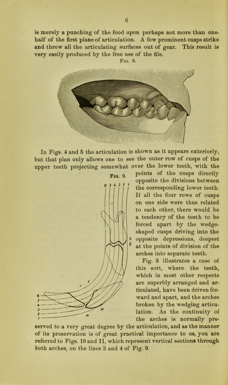 is merely a punching of the food upon perhaps not more than one- half of the first plane of articulation. A few prominent cusps strike and throw all the articulating surfaces out of gear. This result is very easily produced by the free use of the file. Fig. 8. Fig. 9. In Figs. 4 and 5 the articulation is shown as it appears exteriorly, but that plan only allows one to see the outer row of cusps of the upper teeth projecting somewhat over the lower teeth, with the points of the cusps directly opposite the divisions between the corresponding lower teeth. If all the four rows of cusps on one side were thus related to each other, there would be a tendency of the teeth to be forced apart by the wedge- shaped cusps driving into the opposite depressions, deepest at the points of division of the arches into separate teeth. Fig. 8 illustrates a case of this sort, where the teeth, which in most other respects are superbly arranged and ar- ticulated, have been driven for- ward and apart, and the arches broken by the wedging articu- lation. As the continuity of the arches is normally pre- served to a very great degree by the articulation, and as the manner of its preservation is of great practical importance to us, you are referred to Figs. 10 and 11, which represent vertical sections through both arches, on the lines 3 and 4 of Fig. 9.