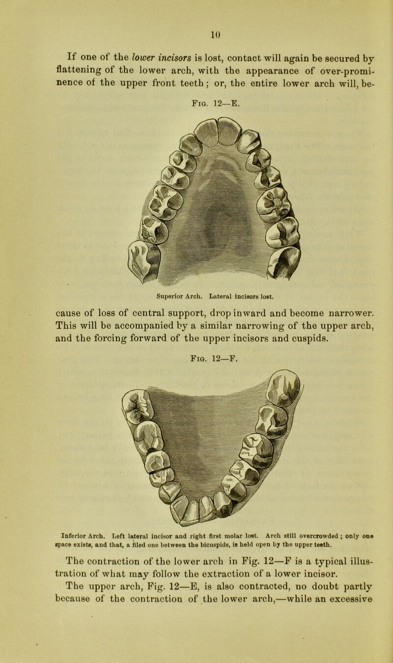 If one of the lower incisors is lost, contact will again be secured by flattening of the lower arch, with the appearance of over-promi- nence of the upper front teeth ; or, the entire lower arch will, be- Fig. 12—E. Superior Arch. Lateral incisors lost. cause of loss of central support, drop inward and become narrower. This will be accompanied by a similar narrowing of the upper arch, and the forcing forward of the upper incisors and cuspids. Fig. 12—F. Inferior Arch. Left lateral incisor and right first molar lost. Arch still overcrowded ; only one space exists, and that, a filed one between the bicuspids, is held open by the upper teeth. The contraction of the lower arch in Fig. 12—F is a typical illus- tration of what may follow the extraction of a lower incisor. The upper arch, Fig. 12—E, is also contracted, no doubt partly because of the contraction of the lower arch,—while an excessive