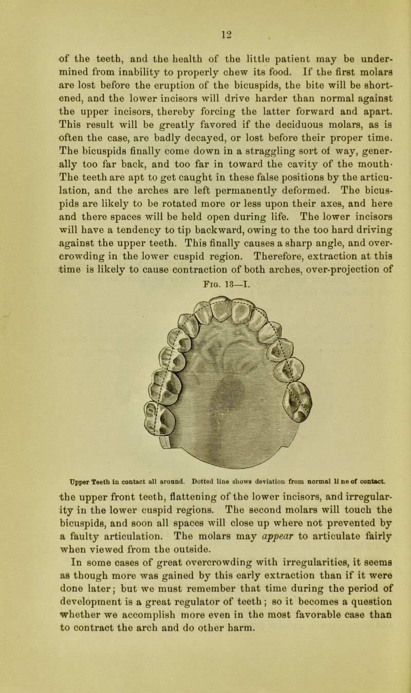 of the teeth, and the health of the little patient may be under- mined from inability to properly chew its food. If the first molars are lost before the eruption of the bicuspids, the bite will be short- ened, and the lower incisors will drive harder than normal against the upper incisors, thereby forcing the latter forward and apart. This result will be greatly favored if the deciduous molars, as is often the case, are badly decayed, or lost before their proper time. The bicuspids finally come down in a straggling sort of way, gener- ally too far back, and too far in toward the cavity of the mouth- The teeth are apt to get caught in these false positions by the articu- lation, and the arches are left permanently deformed. The bicus- pids are likely to be rotated more or less upon their axes, and here and there spaces will be held open during life. The lower incisors will have a tendency to tip backward, owing to the too hard driving against the upper teeth. This finally causes a sharp angle, and over- crowding in the lower cuspid region. Therefore, extraction at this time is likely to cause contraction of both arches, over-projection of Fig. 13—I. Upper Teeth in contact all around. Dotted line shows deviation from normal 11 ne of contact. the upper front teeth, flattening of the lower incisors, and irregular- ity in the lower cuspid regions. The second molars will touch the bicuspids, and soon all spaces will close up where not prevented by a faulty articulation. The molars may appear to articulate fairly when viewed from the outside. In some cases of great overcrowding with irregularities, it seems as though more was gained by this early extraction than if it were done later; but we must remember that time during the period of development is a great regulator of teeth; so it becomes a question whether we accomplish more even in the most favorable case than to contract the arch and do other harm.