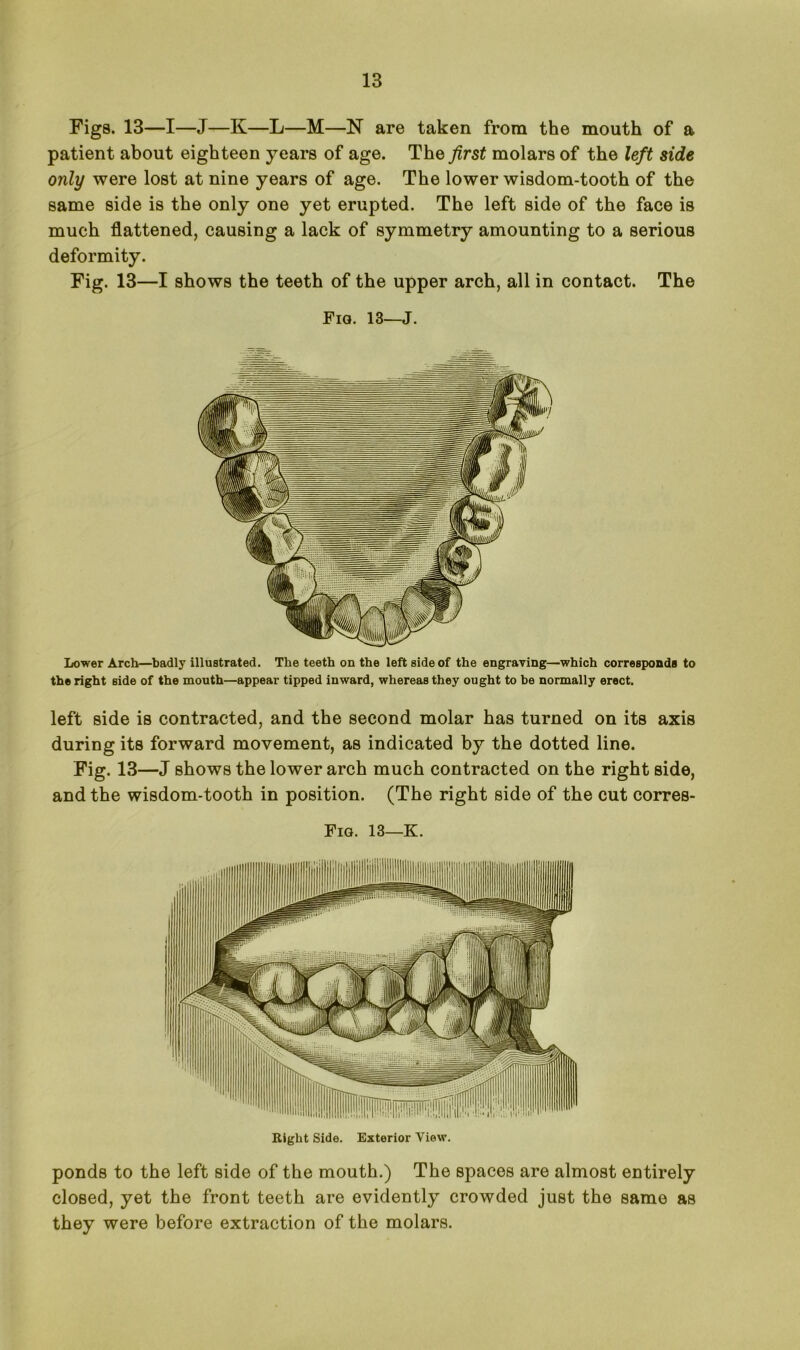 Figs. 13—I—J—K—L—M—N are taken from the mouth of a patient about eighteen years of age. The first molars of the left side only were lost at nine years of age. The lower wisdom-tooth of the same side is the only one yet erupted. The left side of the face is much flattened, causing a lack of symmetry amounting to a serious deformity. Fig. 13—I shows the teeth of the upper arch, all in contact. The Fia. 13—J. Lower Arch—badly illustrated. The teeth on the left side of the engraving—which corresponds to the right side of the mouth—appear tipped inward, whereas they ought to be normally erect. left side is contracted, and the second molar has turned on its axis during its forward movement, as indicated by the dotted line. Fig. 13—J shows the lower arch much contracted on the right side, and the wisdom-tooth in position. (The right side of the cut corres- Fig. 13—K. Right Side. Exterior View. ponds to the left side of the mouth.) The spaces are almost entirely closed, yet the front teeth are evidently crowded just the same as they were before extraction of the molars.