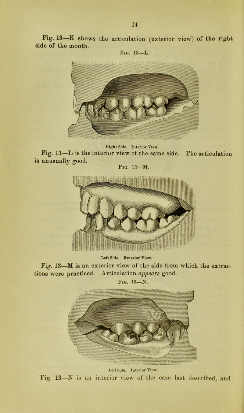 Fig. 13—K shows the articulation (exterior view) of the right side of the mouth. Fig. 13—L. Right Side. Interior View. Fig. 13—L is the interior view of the same side, is unusually good. Fig. 13—M. The articulation Left Side. Exterior View. Fig. 13—M is an exterior view of the side from which the extrac- tions were practiced. Articulation appears good. Fig. 13—N. Leftside. Interior View. Fig. 13—N is an interior view of the case last described, and