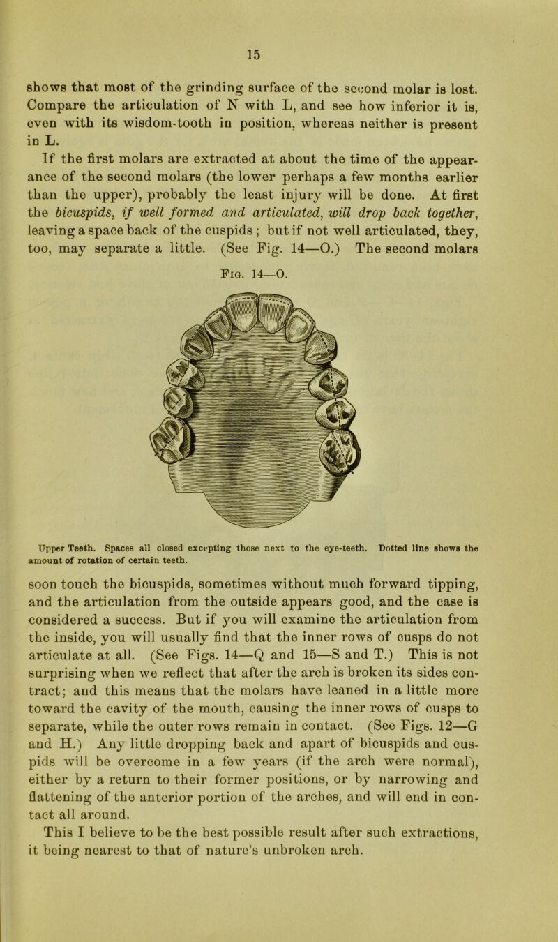shows that most of the grinding surface of the second molar is lost. Compare the articulation of N with L, and see how inferior it is, even with its wisdom-tooth in position, whereas neither is present in L. If the first molars are extracted at about the time of the appear- ance of the second molars (the lower perhaps a few months earlier than the upper), probably the least injury will be done. At first the bicuspids, if well formed and articulated, will drop back together, leaving a space back of the cuspids ; but if not well articulated, they, too, may separate a little. (See Fig. 14—O.) The second molars Fig. 14—O. Upper Teeth. Spaces all closed excepting those next to the eye-teeth. Dotted line shows the amount of rotation of certain teeth. soon touch the bicuspids, sometimes without much forward tipping, and the articulation from the outside appears good, and the case is considered a success. But if you will examine the articulation from the inside, you will usually find that the inner rows of cusps do not articulate at all. (See Figs. 14—Q and 15—S and T.) This is not surprising when we reflect that after the arch is broken its sides con- tract; and this means that the molars have leaned in a little more toward the cavity of the mouth, causing the inner rows of cusps to separate, while the outer rows remain in contact. (See Figs. 12—G and H.) Any little dropping back and apart of bicuspids and cus- pids will be overcome in a few years (if the arch were normal), either by a return to their former positions, or by narrowing and flattening of the anterior portion of the arches, and will end in con- tact all around. This I believe to be the best possible result after such extractions, it being nearest to that of nature’s unbroken arch.