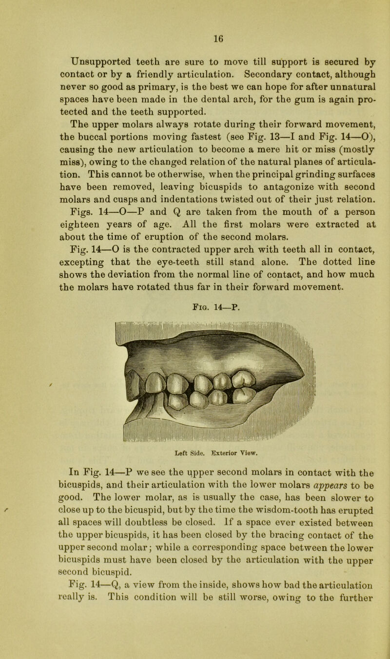 Unsupported teeth are sure to move till support is secured by contact or by a friendly articulation. Secondary contact, although never so good as primary, is the best we can hope for after unnatural spaces have been made in the dental arch, for the gum is again pro- tected and the teeth supported. The upper molars always rotate during their forward movement, the buccal portions moving fastest (see Fig. 13—I and Fig. 14—O), causing the new articulation to become a mere hit or miss (mostly miss), owing to the changed relation of the natural planes of articula- tion. This cannot be otherwise, when the principal grinding surfaces have been removed, leaving bicuspids to antagonize with second molars and cusps and indentations twisted out of their just relation. Figs. 14—O—P and Q are taken from the mouth of a person eighteen years of age. All the first molars were extracted at about the time of eruption of the second molars. Fig. 14—O is the contracted upper arch with teeth all in contact, excepting that the eye-teeth still stand alone. The dotted line shows the deviation from the normal line of contact, and how much the molars have rotated thus far in their forward movement. Fig. 14—P. Left Side. Exterior View. In Fig. 14—P we see the upper second molars in contact with the bicuspids, and their articulation with the lower molars appears to be good. The lower molar, as is usually the case, has been slower to ' close up to the bicuspid, but by the time the wisdom-tooth has erupted all spaces will doubtless be closed. If a space ever existed between the upper bicuspids, it has been closed by the bracing contact of the upper second molar; while a corresponding space between the lower bicuspids must have been closed by the articulation with the upper second bicuspid. Fig. 14—Q, a view from the inside, shows how bad the articulation really is. This condition will be still worse, owing to the further