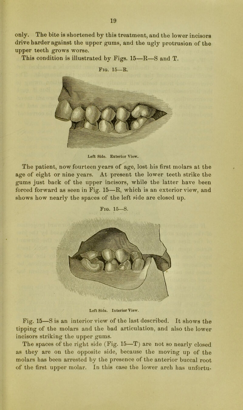 only. The bite is shortened by this treatment, and the lower incisors drive harder against the upper gums, and the ugly protrusion of the upper teeth grows worse. This condition is illustrated by Figs. 15—R—S and T. Fig. 15—R. Left Side. Exterior View. The patient, now fourteen years of age, lost his first molars at the age of eight or nine years. At present the lower teeth strike the gums just back of the upper incisors, while the latter have been forced forward as seen in Fig. 15—R, which is an exterior view, and shows how nearly the spaces of the left side are closed up. Fig. 15—S. Left Side. Interior View. Fig. 15—S is an interior view of the last described. It shows the tipping of the molars and the bad articulation, and also the lower incisors striking the upper gums. The spaces of the right side (Fig. 15—T) are not so near]}7, closed as they are on the opposite side, because the moving up of the molars has been arrested by the presence of the anterior buccal root of the first upper molar. In this case the lower arch has unfortu-