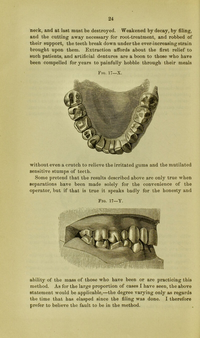 neck, and at last must be destroyed. Weakened by decay, by filing, and the cutting away necessary for root-treatment, and robbed of their support, the teeth break down under the ever-increasing strain brought upon them. Extraction affords about the first relief to such patients, and artificial dentures are a boon to those who have been compelled for years to painfully hobble through their meals Fig. IT—X. without even a crutch to relieve the irritated gums and the mutilated sensitive stumps of teeth. Some pretend that the results described above are only true when separations have been made solely for the convenience of the operator, but if that is true it speaks badly for the honesty and Fig. 17—Y. ability of the mass of those who have been or are practicing this method. As for the large proportion of cases I have seen, the above statement would be applicable,—the degree varying only as regards the time that has elasped since the filing was done. I therefore prefer to believe the fault to be in the method.