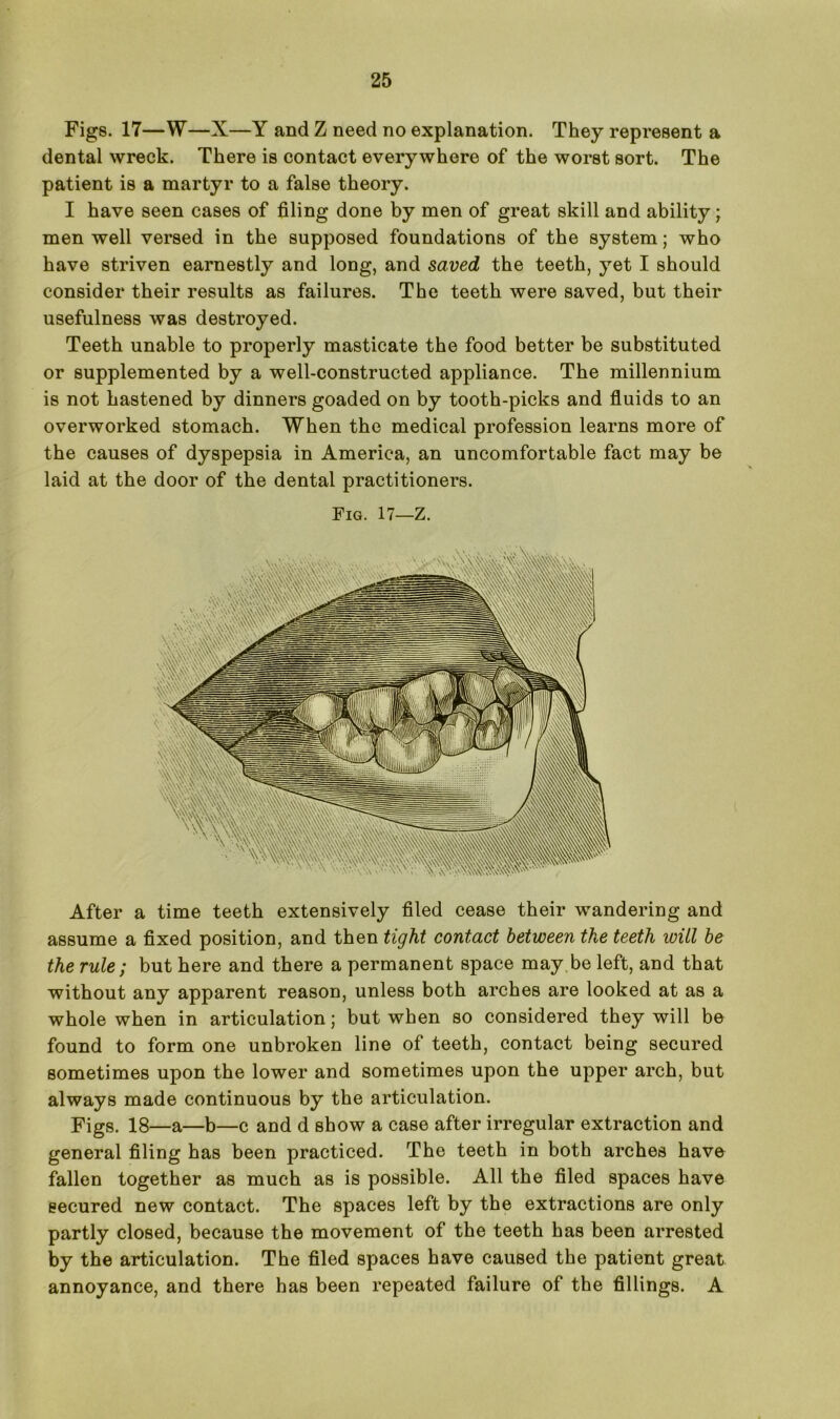 Figs. 17—W—X—Y and Z need no explanation. They represent a dental wreck. There is contact everywhere of the worst sort. The patient is a martyr to a false theory. I have seen cases of filing done by men of great skill and ability; men well versed in the supposed foundations of the system; who have striven earnestly and long, and saved the teeth, yet I should consider their results as failures. The teeth were saved, but their usefulness was destroyed. Teeth unable to properly masticate the food better be substituted or supplemented by a well-constructed appliance. The millennium is not hastened by dinners goaded on by tooth-picks and fluids to an overworked stomach. When the medical profession learns more of the causes of dyspepsia in America, an uncomfortable fact may be laid at the door of the dental practitioners. Fig. 17—Z. After a time teeth extensively filed cease their wandering and assume a fixed position, and then tight contact between the teeth will be the rule; but here and there a permanent space may be left, and that without any apparent reason, unless both arches are looked at as a whole when in articulation; but when so considered they will be found to form one unbroken line of teeth, contact being secured sometimes upon the lower and sometimes upon the upper arch, but always made continuous by the articulation. Figs. 18—a—b—c and d show a case after irregular extraction and general filing has been practiced. The teeth in both arches have fallen together as much as is possible. All the filed spaces have secured new contact. The spaces left by the extractions are only partly closed, because the movement of the teeth has been arrested by the articulation. The filed spaces have caused the patient great annoyance, and there has been repeated failure of the fillings. A