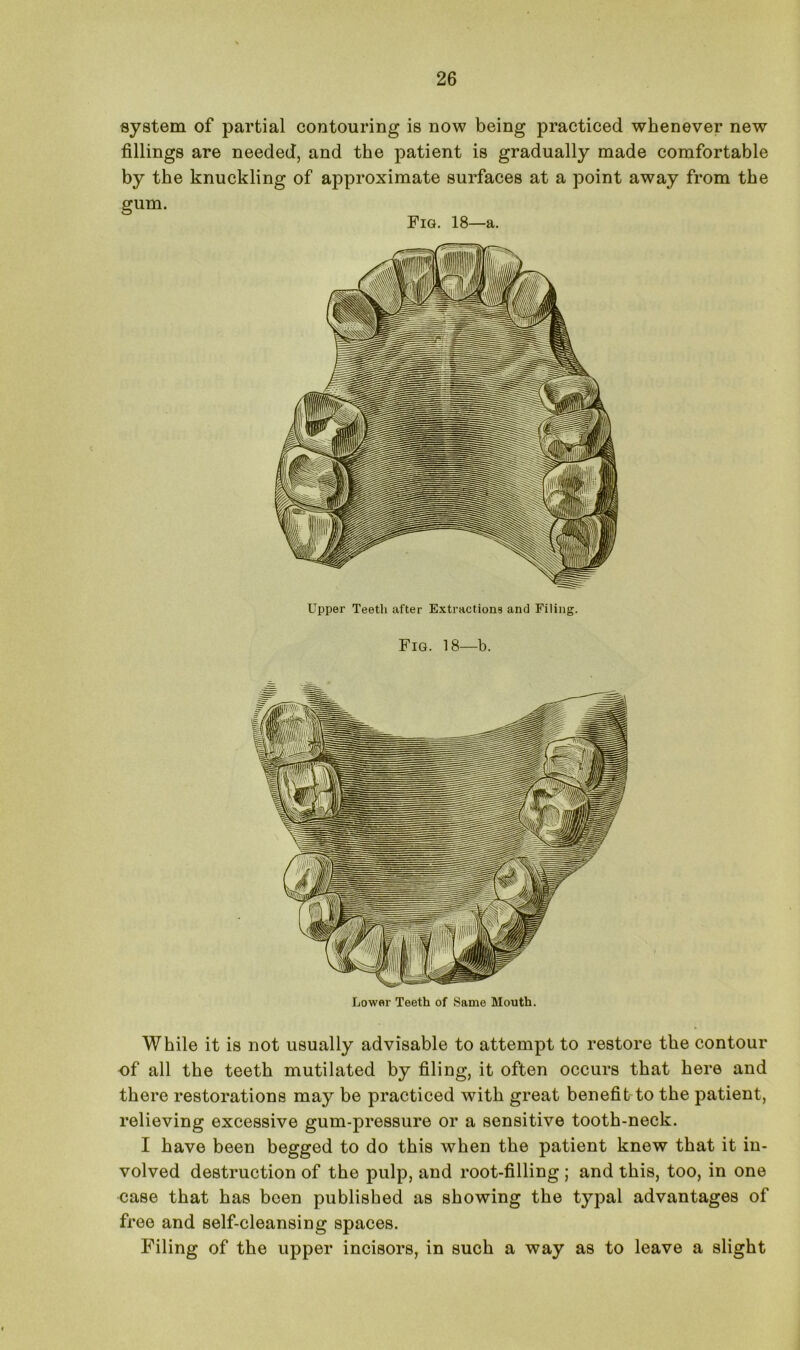 system of partial contouring is now being practiced whenever new fillings are needed, and the patient is gradually made comfortable by the knuckling of approximate surfaces at a point away from the gum. Fig. 18—a. Upper Teeth after Extractions and Filing. Fig. 18—b. Lower Teeth of Same Mouth. While it is not usually advisable to attempt to restore the contour of all the teeth mutilated by filing, it often occurs that here and there restorations may be practiced with great benefit to the patient, relieving excessive gum-pressure or a sensitive tooth-neck. I have been begged to do this when the patient knew that it in- volved destruction of the pulp, and root-filling ; and this, too, in one case that has been published as showing the typal advantages of free and self-cleansing spaces. Filing of the upper incisors, in such a way as to leave a slight