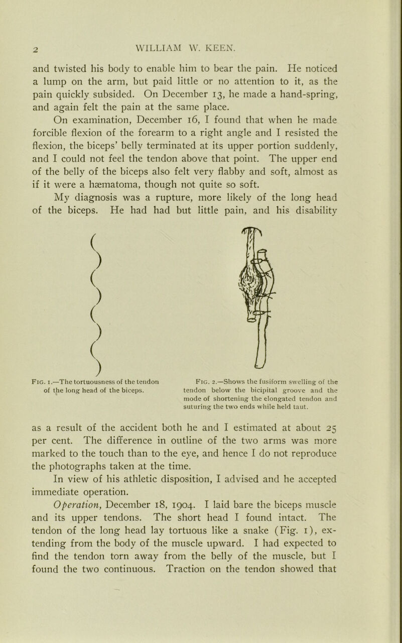 and twisted his body to enable him to bear the pain. He noticed a lump on the arm, but paid little or no attention to it, as the pain quickly subsided. On December 13, he made a hand-spring, and again felt the pain at the same place. On examination, December 16, I found that when he made forcible flexion of the forearm to a right angle and I resisted the flexion, the biceps’ belly terminated at its upper portion suddenly, and I could not feel the tendon above that point. The upper end of the belly of the biceps also felt very flabby and soft, almost as if it were a haematoma, though not quite so soft. My diagnosis was a rupture, more likely of the long head of the biceps. He had had but little pain, and his disability Fig. 1.—The tortuousness of the tendon Fig. 2.—Shows the fusiform swelling of the of the long head of the biceps. tendon below the bicipital groove and the mode of shortening the elongated tendon and suturing the two ends while held taut. as a result of the accident both he and I estimated at about 25 per cent. The difference in outline of the two arms was more marked to the touch than to the eye, and hence I do not reproduce the photographs taken at the time. In view of his athletic disposition, I advised and he accepted immediate operation. Operation, December 18, 1904. I laid bare the biceps muscle and its upper tendons. The short head I found intact. The tendon of the long head lay tortuous like a snake (Fig. 1), ex- tending from the body of the muscle upward. I had expected to find the tendon torn away from the belly of the muscle, but I found the two continuous. Traction on the tendon showed that