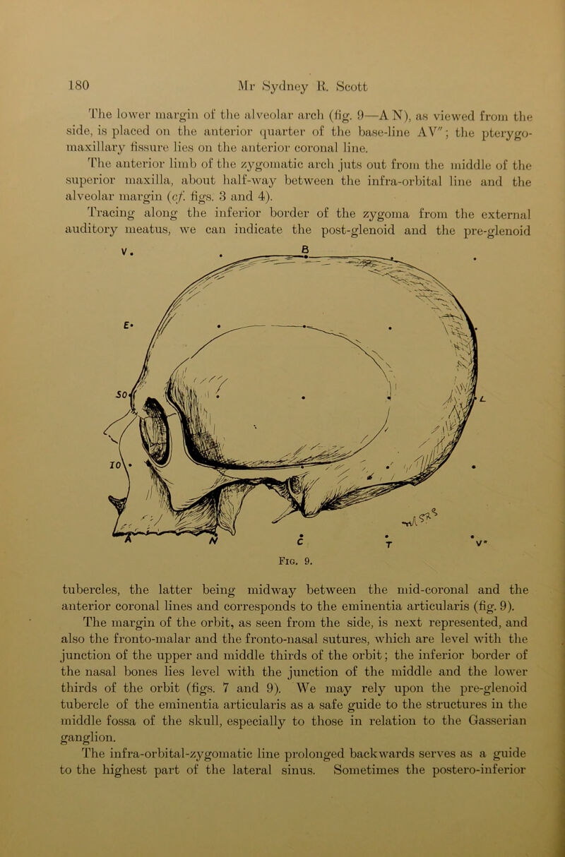 The lower margin of the alveolar arch (fig. 9—AN), as viewed from the side, is placed on the anterior quarter of the base-line AV; the pterygo- maxillary fissure lies on the anterior coronal line. The anterior limb of the zygomatic arch juts out from the middle of the superior maxilla, about half-way between the infra-orbital line and the alveolar margin (of. figs. 3 and 4). Tracing along the inferior border of the zygoma from the external auditory meatus, we can indicate the post-glenoid and the pre-glenoid Fig. 9. tubercles, the latter being midway between the mid-coronal and the anterior coronal lines and corresponds to the eminentia articularis (fig. 9). The margin of the orbit, as seen from the side, is next represented, and also the fronto-malar and the fronto-nasal sutures, which are level with the junction of the upper and middle thirds of the orbit; the inferior border of the nasal bones lies level with the junction of the middle and the lower thirds of the orbit (figs. 7 and 9). We may rely upon the pre-glenoid tubercle of the eminentia articularis as a safe guide to the structures in the middle fossa of the skull, especially to those in relation to the Gasserian ganglion. The infra-orbital-zygomatic line prolonged backwards serves as a guide to the highest part of the lateral sinus. Sometimes the postero-inferior