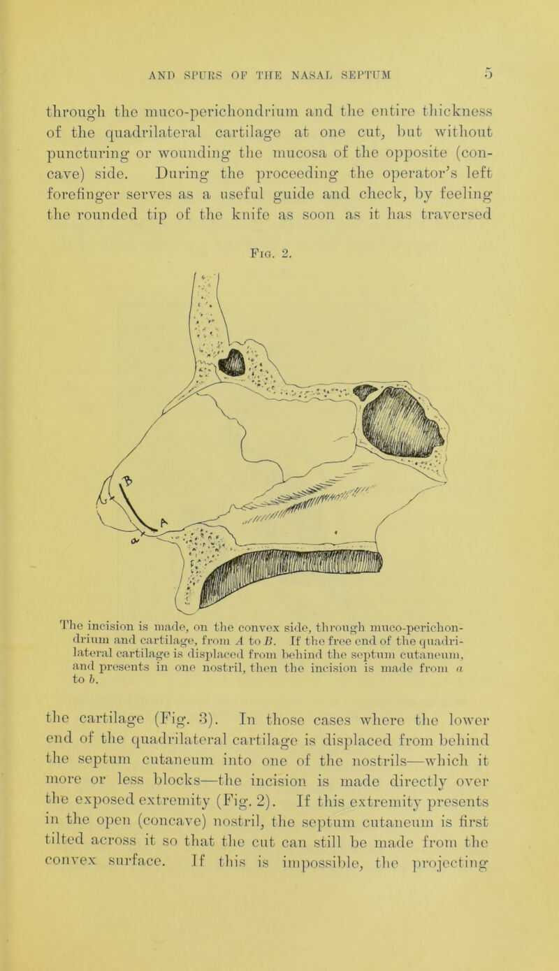 through the muco-perichondrium and the entire thickness of the quadrilateral cartilage at one cut, but without puncturing or wounding the mucosa of the opposite (con- cave) side. During the proceeding the operator’s left forefinger serves as a useful guide and check, by feeling the rounded tip of the knife as soon as it has traversed Fig. 2. The incision is made, on the convex side, through muco-perichon- drimn and cartilage, from A to B. If the free end of the quadri- lateral cartilage is displaced from behind the septum cutaneum, and presents in one nostril, then the incision is made from a to b. the cartilage (Fig. 8). In those cases where the lower end of the quadrilateral cartilage is displaced from behind the septum cutaneum into one of the nostrils—which it more or less blocks—the incision is made directly over the exposed extremity (Fig. 2). If this extremity presents in the open (concave) nostril, the septum cutaneum is first tilted across it so that the cut can still be made from the convex surface. If this is impossible, the projecting