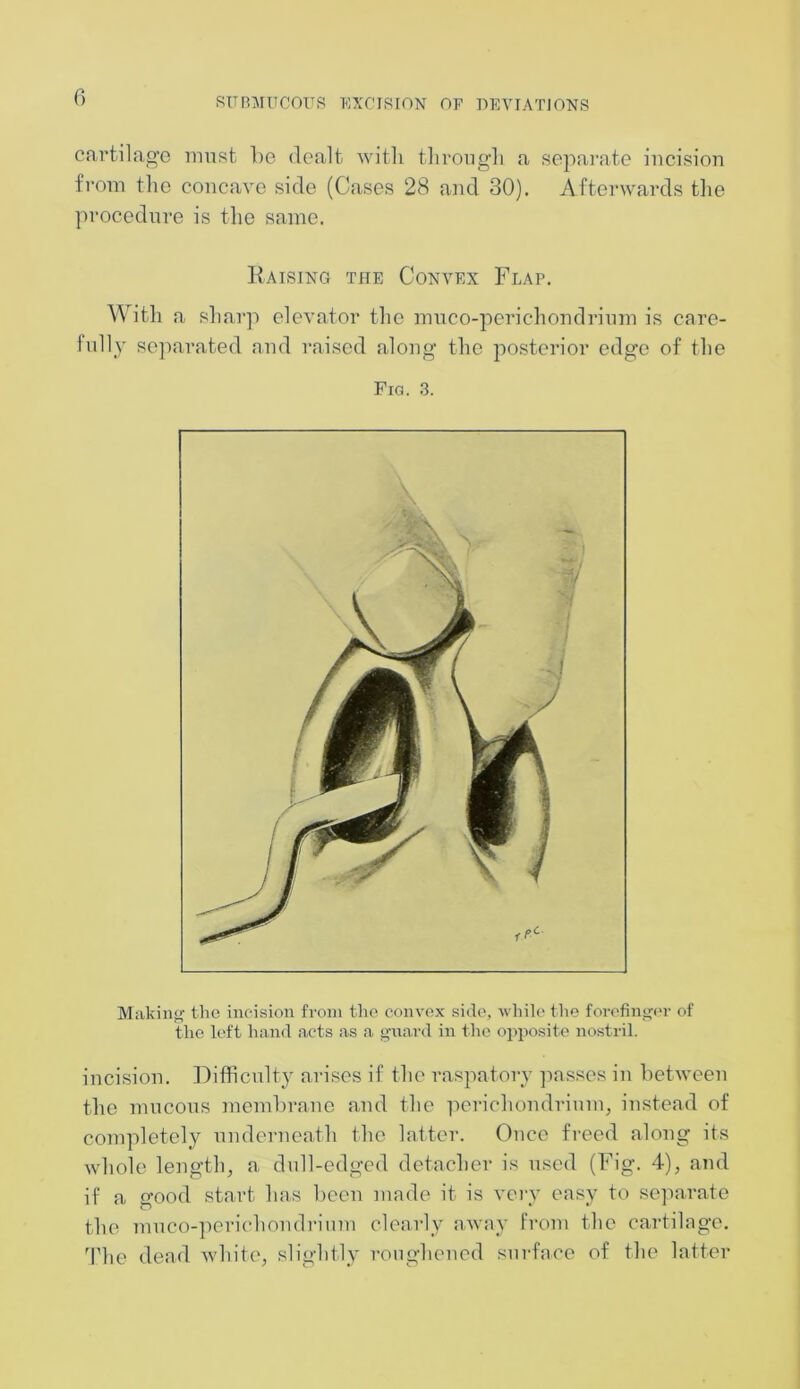 cartilage must lie dealt with through a separate incision from the concave side (Cases 28 and 30). Afterwards the procedure is the same. Raising the Convex Flap. With a sharp elevator the muco-perichondrium is care- fully separated and raised along the posterior edge of the Fig. 3. Making the incision from the convex side, while the forefinger of the left hand acts as a guard in the opposite nostril. incision. Difficulty arises if the raspatory passes in between the mucous membrane and the perichondrium, instead of completely underneath the latter. Once freed along its whole length, a dull-edged detacher is used (Fig. 4), and if a good start has been made it is very easy to separate the muco-perichondrium clearly away from the cartilage. The dead white, slightly roughened surface of the latter