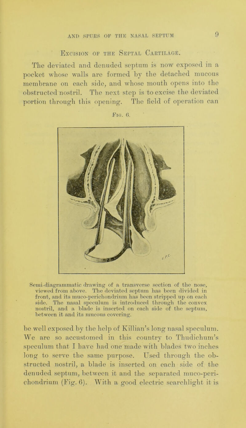 Excision op the Septal Cartilage. The deviated and denuded septum is now exposed in a pocket whose walls are formed by the detached mucous membrane on each side, and whose mouth opens into the obstructed nostril. The next step is to excise the deviated portion through this opening*. The field of operation can Fig. 0. Semi-diagrammatic drawing of a transverse section of the nose, viewed from above. The deviated septum has been divided in front, and its mnco-perichondrium has been stripped up on each side. The nasal speculum is introduced through the convex nostril, and a blade is inserted on each side of the septum, between it and its mucous covering. be well exposed by the help of Killian’s long nasal speculum. We are so accustomed in this country to Tlmdichum’s speculum that I have had one made with blades two inches long to serve the same purpose. Used through the ob- structed nostril, a blade is inserted on each side of the denuded septum, between it and the separated muco-peri- chondrium (Fig. 6). With a, good electric searchlight it is
