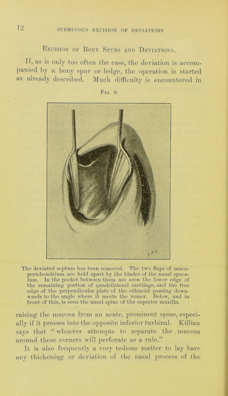 SUBMUCOUS EXCISION OF DEVIATIONS Excision of Bony Spurs and Deviations. If, as is only too often the case, the deviation is accom- panied by a bony spur or ledge, the operation is started as already described. Much difficulty is encountered in Fig. 9. The deviated septum has been removed. The two flaps of muco- perichondrium are held apart by the blades of tlie nasal specu- lum. In the pocket between them are seen the lower edge of the remaining portion of quadrilateral cartilage, and the free edge of the perpendicular plate of the ethmoid passing down- wards to the angle where it meets the vomer. Below, and in front of this, is seen the nasal spine of the superior maxilla. raising the mucosa from an acute, prominent spine, especi- ally if it presses into the opposite inferior turbinal. Killian says that “ whoever attempts to separate the mucosa around these corners will perforate as a rule.” It is also frequently a very tedious matter to lay bare any thickening or deviation of the nasal process of the
