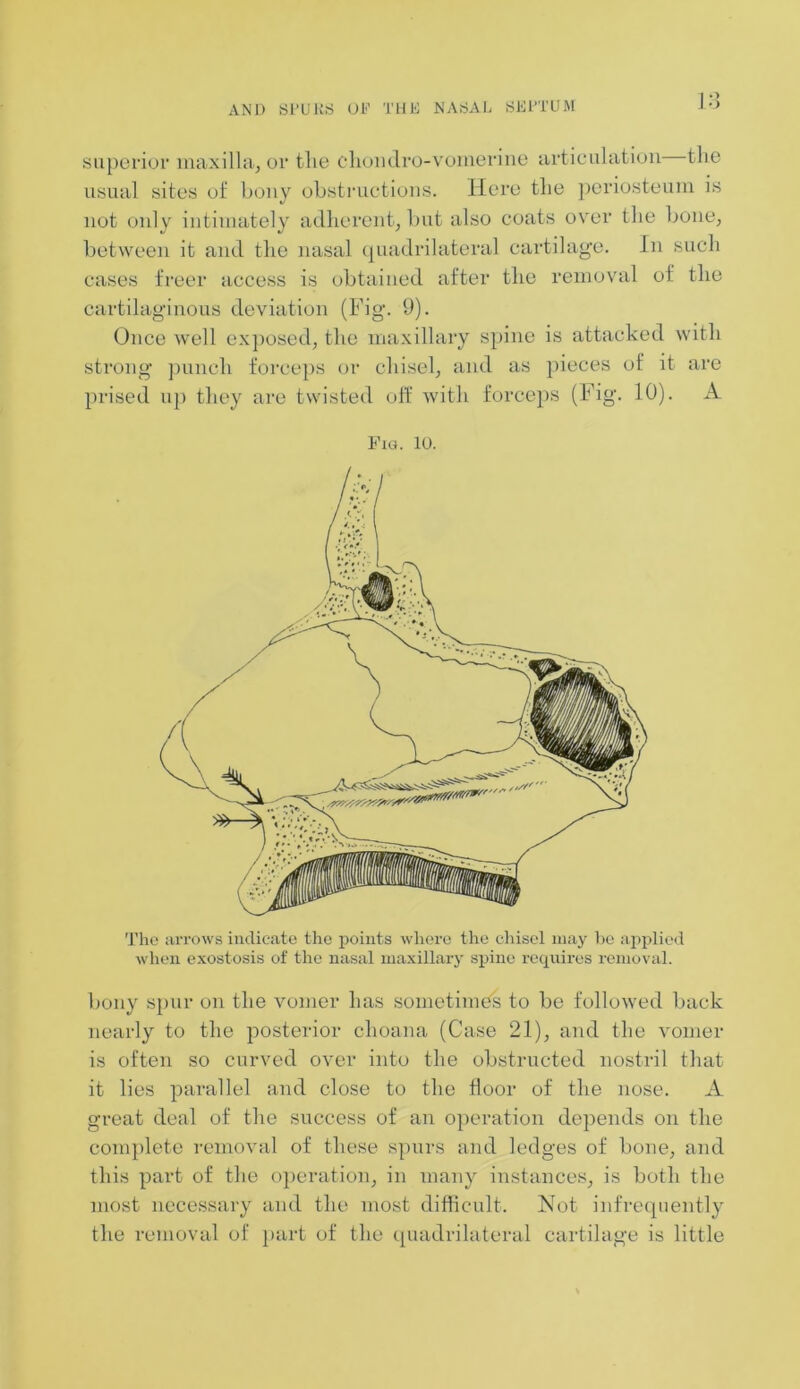 superior maxilla, or tlie chondro-vomerine articulation the usual sites of bony obstructions. Here the periosteum is not only intimately adherent, but also coats over the bone, between it and the nasal quadrilateral cartilage. In such cases freer access is obtained after the removal of the cartilaginous deviation (Fig. 9). Once well exposed, the maxillary spine is attacked with strong punch forceps or chisel, and as pieces of it are prised up they are twisted off with forceps (Fig. 10). A Fig. 10. The arrows indicate the points where the chisel may be applied when exostosis of the nasal maxillary spine requires removal. bony spur on the vomer has sometimes to be followed back nearly to the posterior choana (Case 21), and the vomer is often so curved over into the obstructed nostril that it lies parallel and close to the floor of the nose. A great deal of the success of an operation depends on the complete removal of these spurs and ledges of bone, and this part of the operation, in many instances, is both the most necessary and the most difficult. Not infrequently the removal of part of the quadrilateral cartilage is little