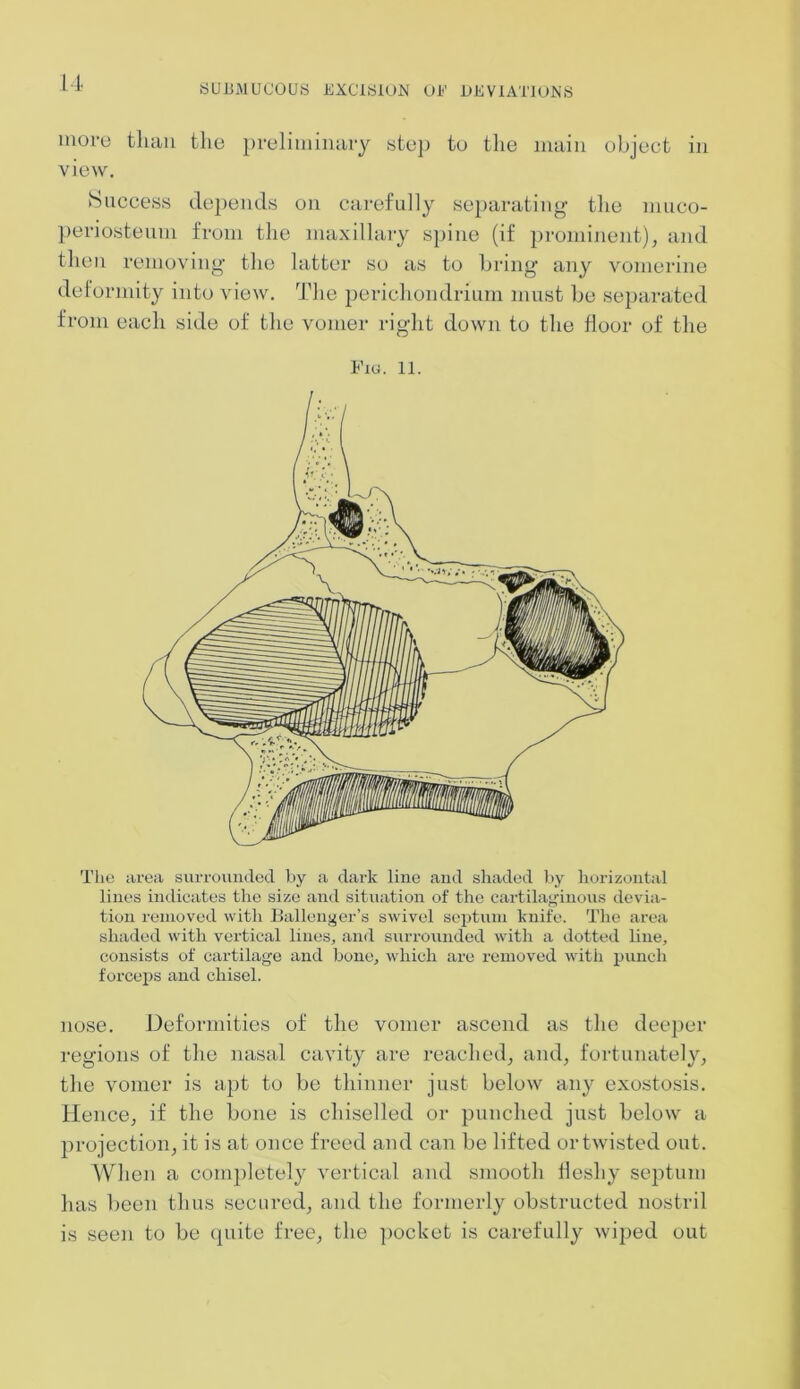 SUEMUCOUS EXCISION OE DEVIATIONS moi-e than the preliminary step to the main object in view. Success depends on carefully separating the niuco- periosteum from the maxillary spine (if prominent), and then removing the latter so as to bring any vomerine deformity into view. The perichondrium must be separated from each side of the vomer right down to the floor of the Fig. 11. The area surrounded by a dark line and shaded by horizontal lines indicates the size and situation of the cartilaginous devia- tion removed with Ballenger’s swivel septum knife. The area shaded with vertical lines, and surrounded with a dotted line, consists of cartilage and bone, which are removed with punch forceps and chisel. nose. Deformities of the vomer ascend as the deeper regions of the nasal cavity are reached, and, fortunately, the vomer is apt to be thinner just below any exostosis. Hence, if the bone is chiselled or punched just below a projection, it is at once freed and can be lifted or twisted out. When a completely vertical and smooth fleshy septum has been thus secured, and the formerly obstructed nostril is seen to be quite free, the pocket is carefully wiped out