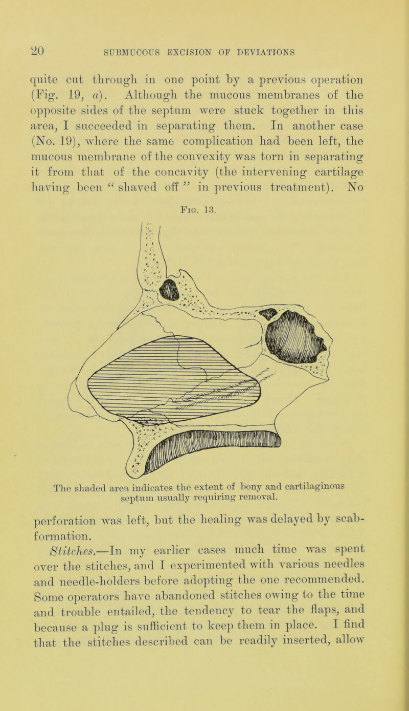 quite cut through in one point by a previous operation (Fig. 19, a). Although the mucous membranes of the opposite sides of the septum were stuck together in this area, I succeeded in separating them. In another case (No. 19), where the same complication had been left, the mucous membrane of the convexity was torn in separating it from that of the concavity (the intervening cartilage having been “ shaved off ” in previous treatment). No Fio. 13. The shaded area indicates the extent of bony and cartilaginous septum usually requiring removal. perforation was left, but the healing was delayed by scab- formation. Stitches.—In my earlier cases much time was spent over the stitches, and I experimented with various needles and needle-holders before adopting the one recommended. Some operators have abandoned stitches owing to the time and trouble entailed, the tendency to tear the flaps, and because a plug is sufficient to keep them in place. I find that the stitches described can be readily inserted, allow
