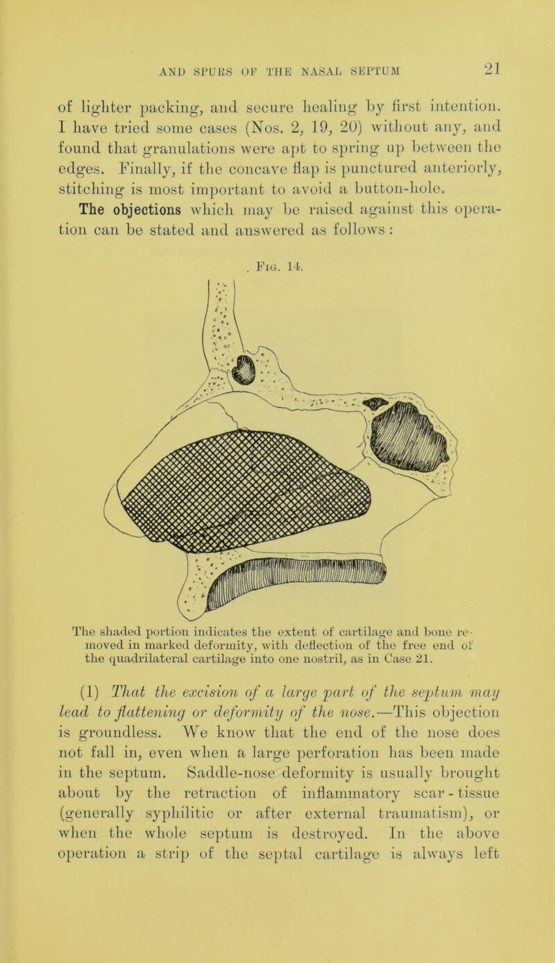 of lighter packing, and secure healing by first intention. I have tried some cases (Nos. 2, 19, 20) without any, and found that granulations were apt to spring up between the edges. Finally, if the concave flap is punctured anteriorly, stitching is most important to avoid a button-hole. The objections which may be raised against this opera- tion can be stated and answered as follows : . Fig. 14. The shaded portion indicates the extent of cartilage and bone re- moved in marked deformity, with deflection of the free end of the quadrilateral cartilage into one nostril, as in Case 21. (1) That the excision of a large part of the septum mag lead to flattening or deformity of the nose.—This objection is groundless. We know that the end of the nose does not fall in, even when a large perforation has been made in the septum. Saddle-nose deformity is usually brought about by the retraction of inflammatory scar - tissue (generally syphilitic or after external traumatism), or when the whole septum is destroyed. In the above operation a strip of the septal cartilage is always left