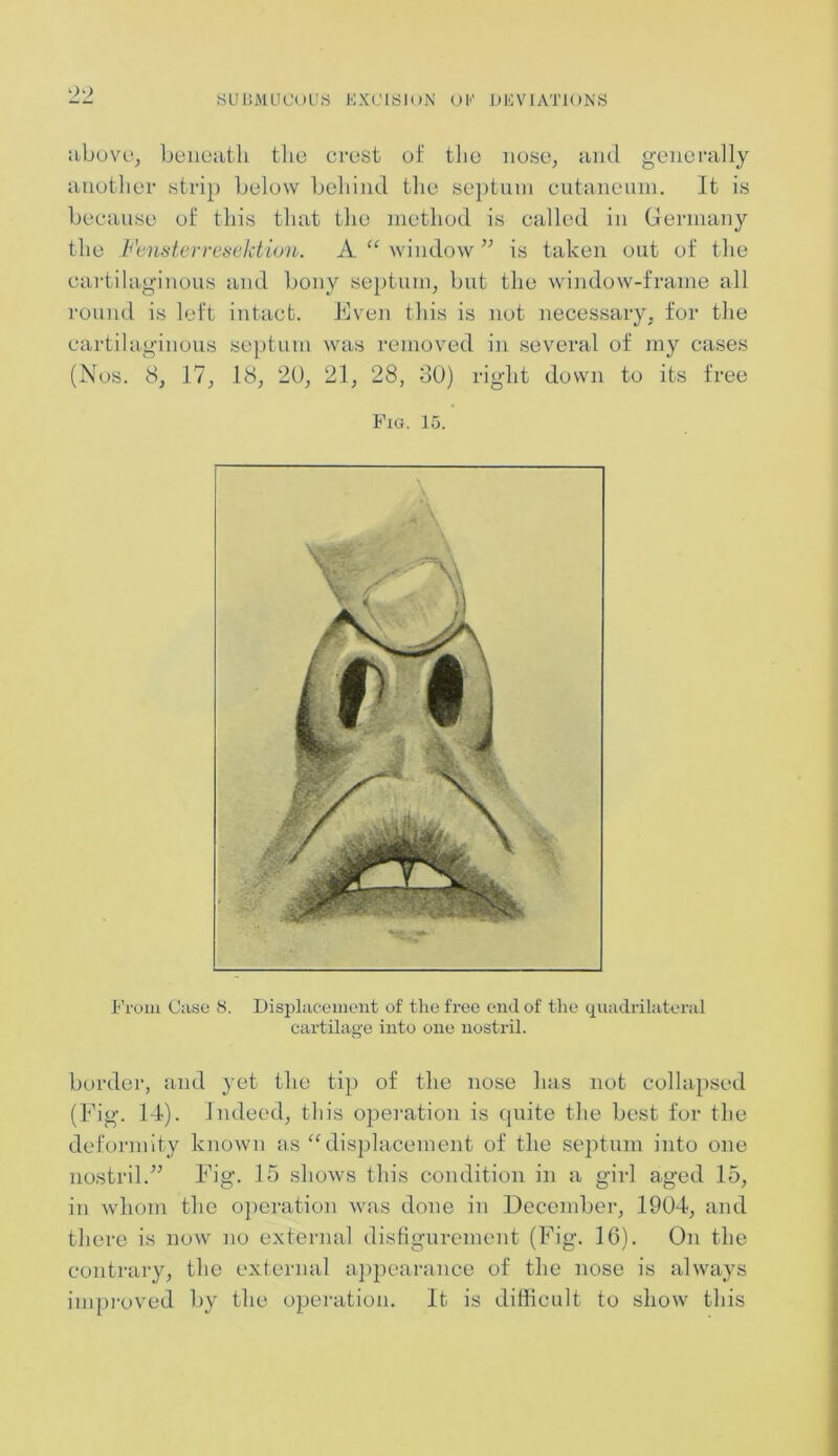 90 above, beneath the crest of the nose, and generally another strip below behind the septum cutaneum. It is because of this that the method is called in Germany the Fensterresektion. A “ window ” is taken out of the cartilaginous and bony septum, but the window-frame all round is left intact. Even this is not necessary, for the cartilaginous septum was removed in several of my cases (Nos. 8, 17, 18, 20, 21, 28, 30) right down to its free Pig. 15. From Case 8. Displacement of the free end of the quadrilateral cartilage into one nostril. border, and yet the tip of the nose has not collapsed (Fig. 14). Indeed, this operation is quite the best for the deformity known as “displacement of the septum into one nostril.” Fig. 15 shows this condition in a girl aged 15, in whom the operation was done in December, 1904, and there is now no external disfigurement (Fig. 16). On the contrary, the external appearance of the nose is always improved by the operation. It is difficult to show this