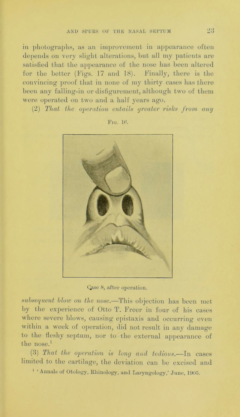 in photographs, as an improvement in appearance often depends on very slight alterations, but all my patients are satisfied that the appearance of the nose has been altered for the better (Figs. 17 and 18). Finally, there is the convincing proof that in none of my thirty cases has there been any falling-in or disfigurement, although two of them were operated on two and a half years ago. (2) That the operation entails (jreater rinks from any Fig. 16. Qise 8, after operation. subsequent blow on the nose.—This objection has been met by the experience of Otto T. Freer in four of his cases where severe blows, causing epistaxis and occurring even within a week of operation, did not result in any damage to the fleshy septum, nor to the external appearance of the nose.1 (3) That the operation is long and tedious.—In cases limited to the cartilage, the deviation can be excised and 1 ‘ Annals of Otology, lihinology, and Laryngology,’ June, 1905.