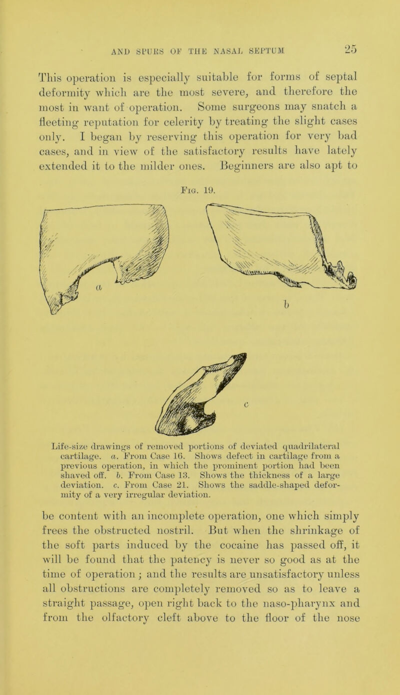 This operation is especially suitable for forms of septal deformity which are the most severe, and therefore the most in want of operation. Some surgeons may snatch a fleeting reputation for celerity by treating the slight cases only. I began by reserving this operation lor very bad cases, and in view of the satisfactory results have lately extended it to the milder ones. Beginners are also apt to Fig. 19. b Life-size drawings of removed portions of deviated quadrilateral cartilage, a. From Case 16. Shows defect in cartilage from a previous operation, in which the prominent portion had been shaved oft', b. From Case 13. Shows the thickness of a large deviation, c. From Case 21. Shows the saddle-shaped defor- mity of a very irregular deviation. be content with an incomplete operation, one which simply frees the obstructed nostril. But when the shrinkage of the soft parts induced by the cocaine has passed off, it will be found that the patency is never so good as at the time of operation ; and the results are unsatisfactory unless all obstructions are completely removed so as to leave a straight passage, open right back to the naso-pliarynx and from the olfactory cleft above to the floor of the nose