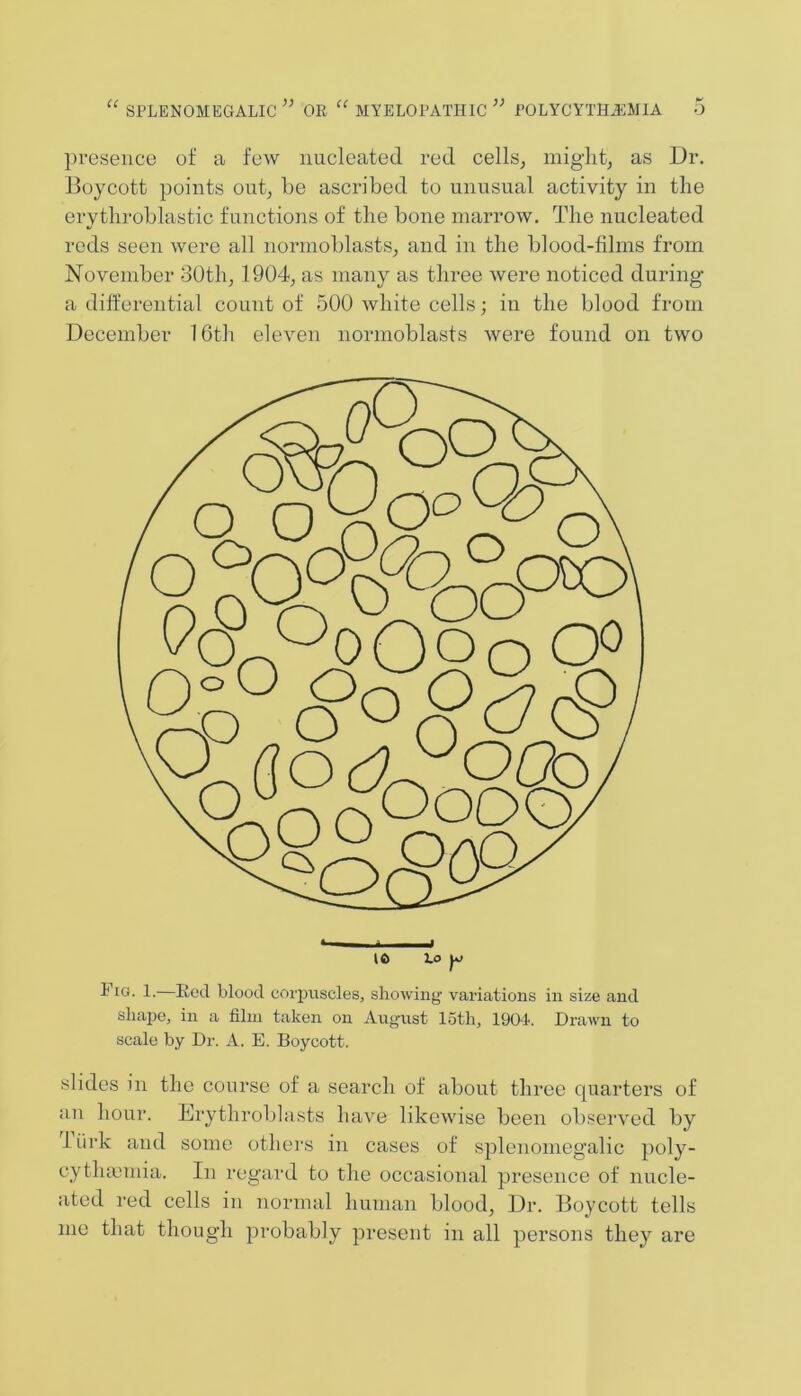 presence of a few nucleated red cells, might, as Dr. Boycott points out, be ascribed to unusual activity in the erythroblastic functions of the bone marrow. The nucleated reds seen were all normoblasts, and in the blood-films from November 30th, 1904, as many as three were noticed during a differential count of 500 white cells; in the blood from December 16th eleven normoblasts were found on two “^odooCfi irocb Oooo, Q(& 10 to t iG. 1.—Red blood corpuscles, showing variations in size and shape, in a film taken on August loth, 1904. Drawn to scale by Dr. A. E. Boycott. slides in the course of a search of about three cpiarters of an hour. Drythroblasts have likewise been observed by 1 iirk and some others in cases of splenomegalic poly- cytlunmia. In regard to the occasional presence of nucle- ated red cells in normal human blood, Dr. Boycott tells me that though probably present in all persons they are