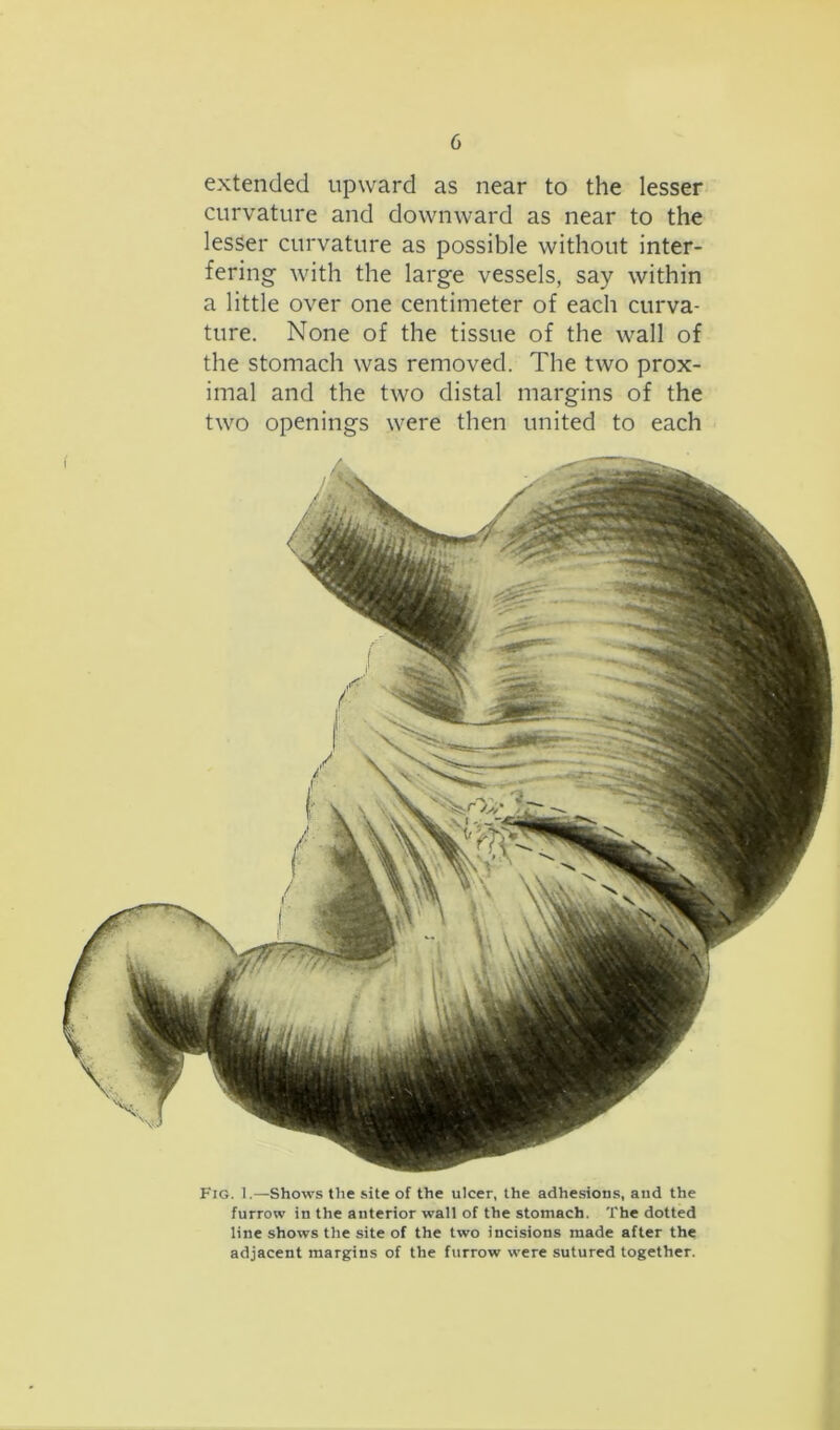 extended upward as near to the lesser curvature and downward as near to the lesser curvature as possible without inter- fering with the large vessels, say within a little over one centimeter of each curva- ture. None of the tissue of the wall of the stomach was removed. The two prox- imal and the two distal margins of the two openings were then united to each Fig. 1.—Shows the site of the ulcer, the adhesions, and the furrow in the anterior wall of the stomach. The dotted line shows the site of the two incisions made after the adjacent margins of the furrow were sutured together.