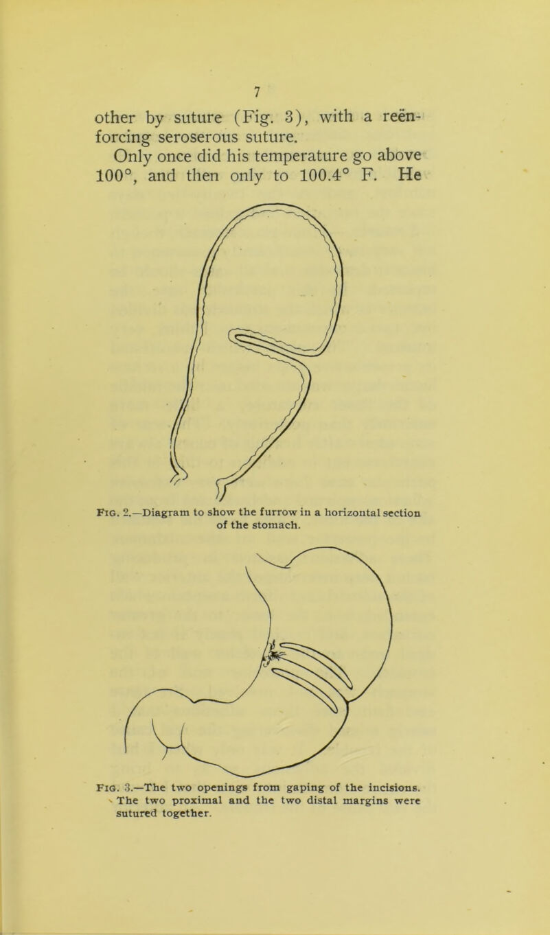 other by suture (Fig. 3), with a reen- forcing seroserous suture. Only once did his temperature go above 100°, and then only to 100.4° F. He Fig. 2.—Diagram to show the furrow in a horizontal section of the stomach. Fig. 3.—The two openings from gaping of the incisions. ' The two proximal and the two distal margins were sutured together.