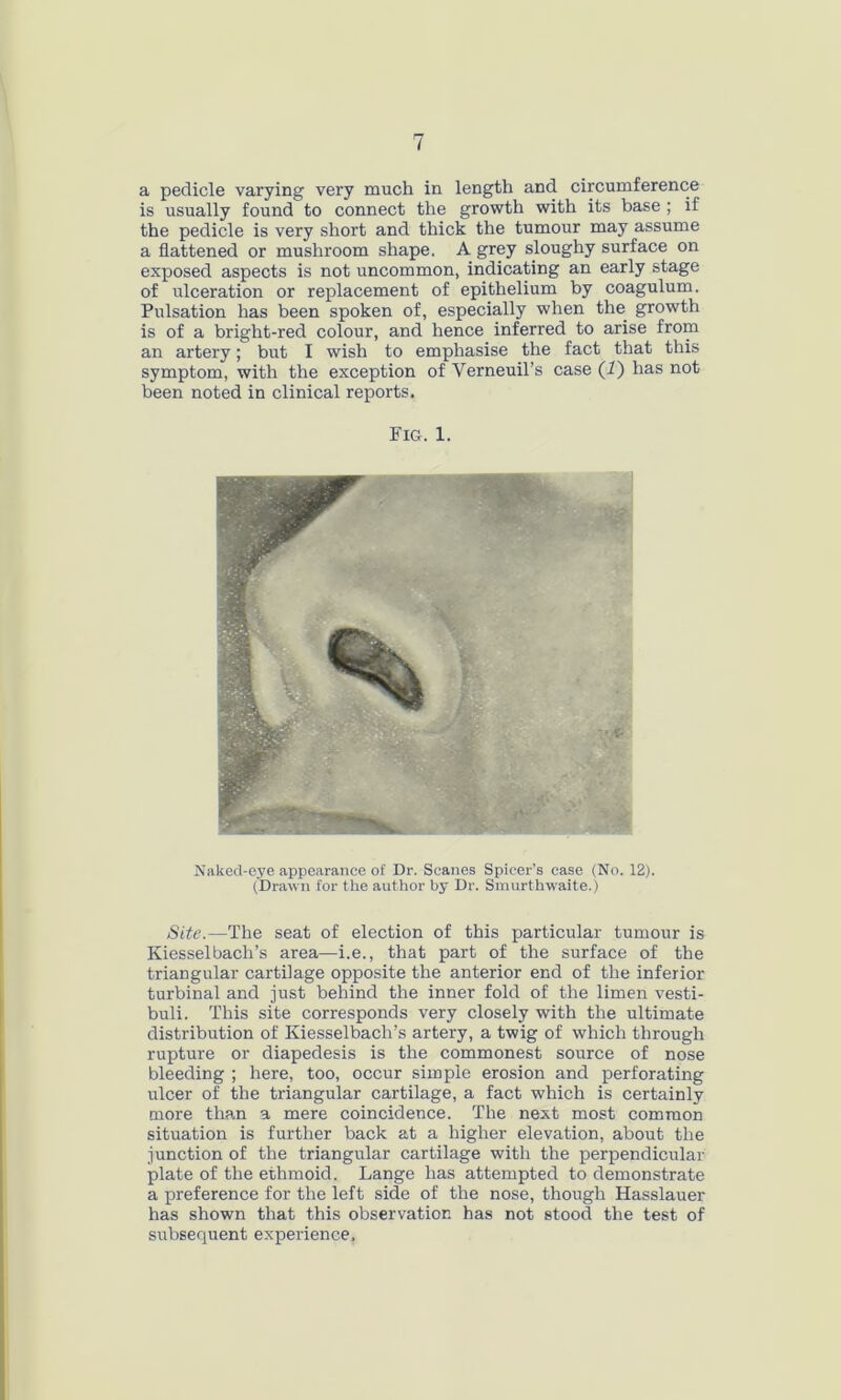 a pedicle varying very much in length and circumference is usually found to connect the growth with its base ; if the pedicle is very short and thick the tumour may assume a flattened or mushroom shape. A grey sloughy surface on exposed aspects is not uncommon, indicating an early stage of ulceration or replacement of epithelium by coagulum. Pulsation has been spoken of, especially when the growth is of a bright-red colour, and hence inferred to arise from an artery; but I wish to emphasise the fact that this symptom, with the exception of Verneuil’s case (1) has not been noted in clinical reports. Fig. 1. Naked-eye appearance of Dr. Scanes Spicer’s case (No. 12). (Drawn for the author by Dr. Smurthwaite.) Site.—The seat of election of this particular tumour is Kiesselbach’s area—i.e., that part of the surface of the triangular cartilage opposite the anterior end of the inferior turbinal and just behind the inner fold of the limen vesti- buli. This site corresponds very closely with the ultimate distribution of Kiesselbach’s artery, a twig of which through rupture or diapedesis is the commonest source of nose bleeding ; here, too, occur simple erosion and perforating ulcer of the triangular cartilage, a fact which is certainly more than a mere coincidence. The next most common situation is further back at a higher elevation, about the junction of the triangular cartilage with the perpendicular plate of the ethmoid. Lange has attempted to demonstrate a preference for the left side of the nose, though Hasslauer has shown that this observation has not stood the test of subsequent experience.