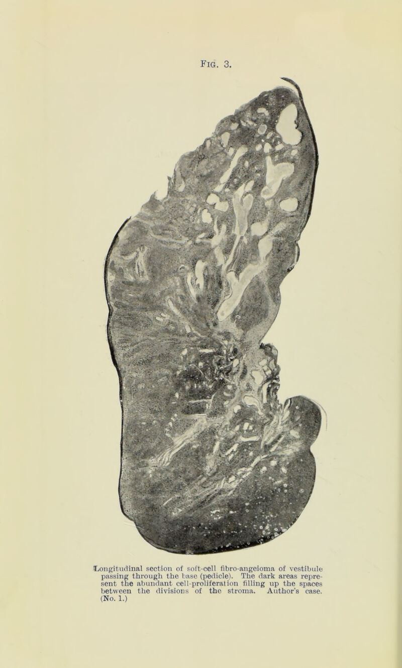 Longitudinal section of soft-cell fibro-angeioma of vestibule passing through the base (pedicle). The dark areas repre- sent the abundant cell-proliferation filling up the spaces between the divisions of the stroma. Author’s case. (No. 1.)