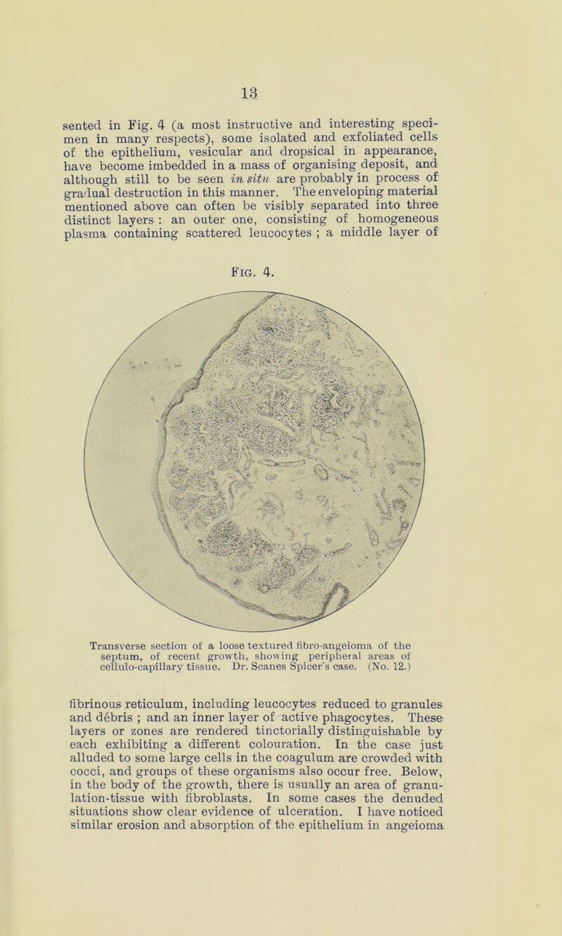 IB sentecl in Fig. 4 (a most instructive and interesting speci- men in many respects), some isolated and exfoliated cells of the epithelium, vesicular and dropsical in appearance, have become imbedded in a mass of organising deposit, and although still to be seen in situ are probably in process of gradual destruction in this manner. The enveloping material mentioned above can often be visibly separated into three distinct layers : an outer one, consisting of homogeneous plasma containing scattered leucocytes ; a middle layer of Fig. 4. Transverse section of a loose textured fibro-angeioma of the septum, of recent, growth, showing peripheral areas of cellulo-capillary tissue. Dr. Scanes Spicer's case. (No. 12.) fibrinous reticulum, including leucocytes reduced to granules and debris ; and an inner layer of active phagocytes. These layers or zones are rendered tinctorially distinguishable by each exhibiting a different colouration. In the case just alluded to some large cells in the coagulum are crowded with cocci, and groups of these organisms also occur free. Below, in the body of the growth, there is usually an area of granu- lation-tissue with fibroblasts. In some cases the denuded situations show clear evidence of ulceration. I have noticed similar erosion and absorption of the epithelium in angeioma