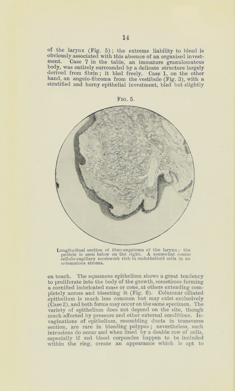 of the larynx (Fig. 5) ; the extreme liability to bleed is obviously associated with this absence of an organised invest- ment. Case 7 in the table, an immature granulomatous body, was entirely surrounded by a delicate structure largely derived from fibrin ; it bled freely. Case 1, on the other hand, an angeio-fibroma from the vestibule (Fig. 3), with a stratified and horny epithelial investment, bled but slightly Fig. 5. Longitudinal section of libro-angeioma of the larynx ; the pedicle is seen below on the right. A somewhat coarse cellulo-capillary meshworlc rich in endothelioid ceils in an cedematous stroma. on touch. The squamous epithelium shows a great tendency to proliferate into the body of the growth, sometimes forming a cornified imbricated mass or cone, at others extending com- pletely across and bisecting it (Fig. 6). Columnar ciliated epithelium is much less common but may exist exclusively (Case 2), and both forms may occur on the same specimen. The variety of epithelium does not depend on the site, though much affected by pressure and other external conditions. In- vaginations of epithelium, resembling ducts in transverse section, are rare in bleeding polypus ; nevertheless, such intrusions do occur and when lined by a double row of cells, especially if red blood corpuscles happen to be included within the ring, create an appearance which is apt to